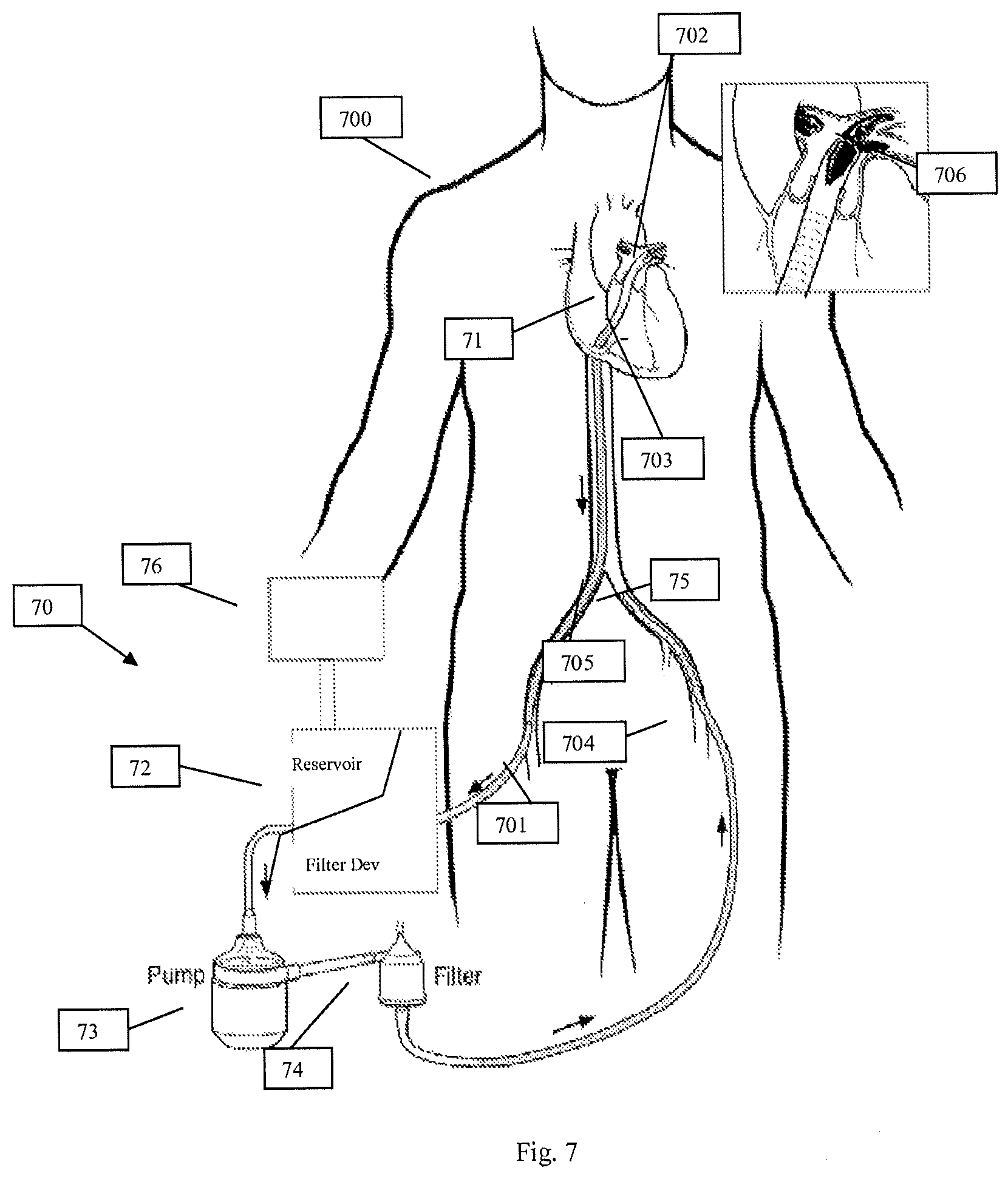 Patent US12616489 Figure 11 – Systems and methods for removing undesirable material within a circulatory system during a surgical procedure