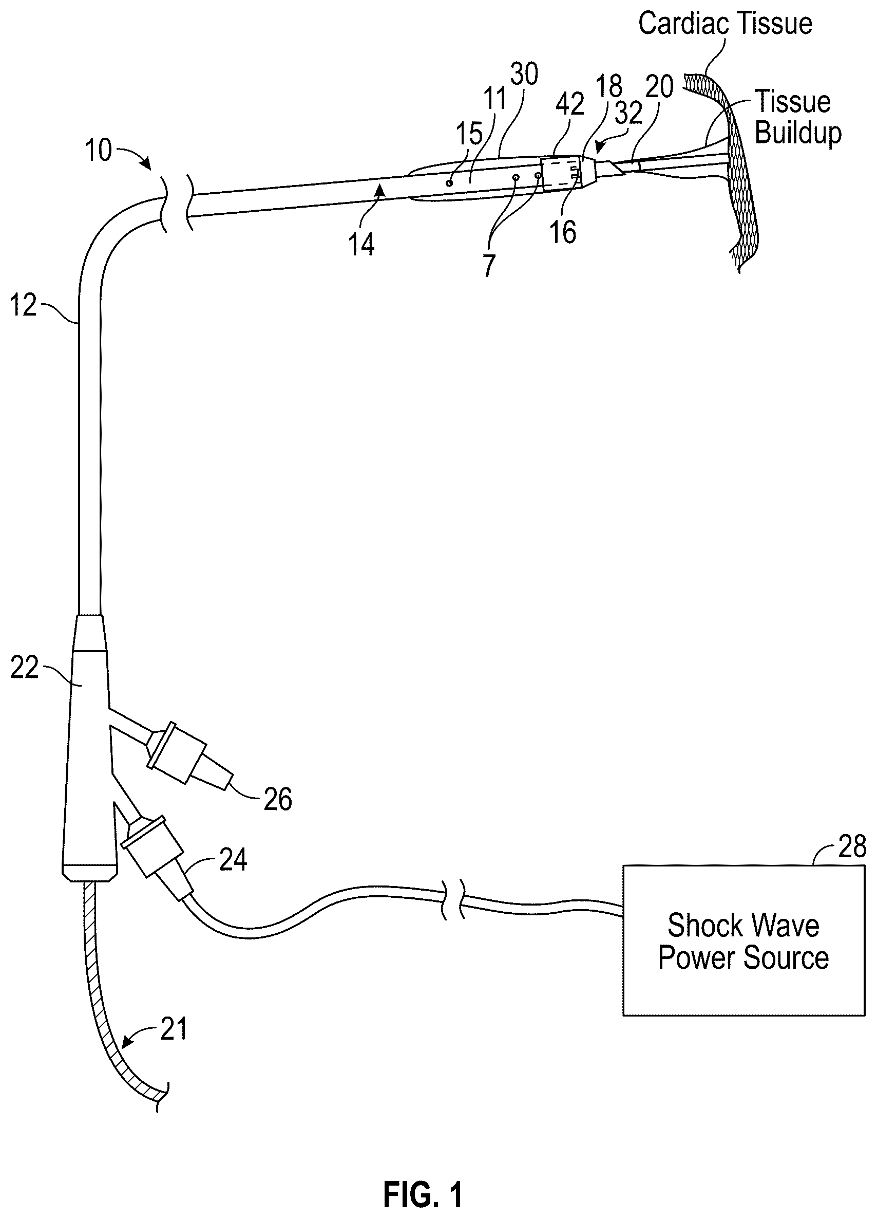 Patent US12616490 — Systems, devices, and methods for treatment of target material in a body lumen with shock waves — Figure 1