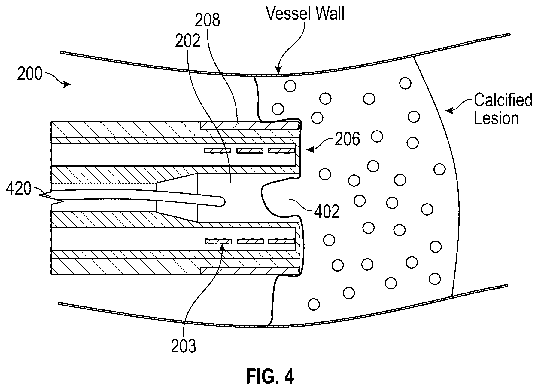 Patent US12616490 Figure 7 – Systems, devices, and methods for treatment of target material in a body lumen with shock waves