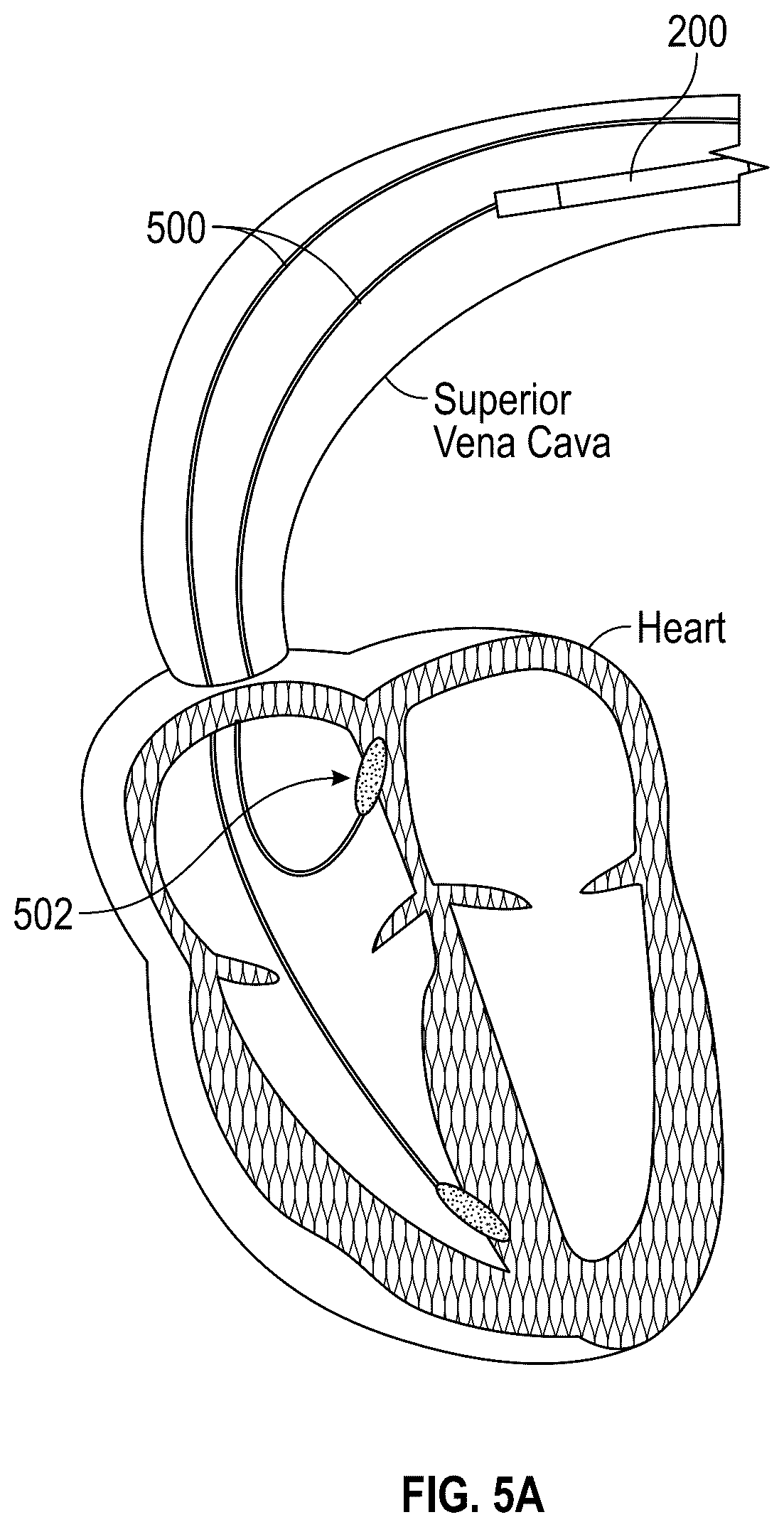 Patent US12616490 Figure 8 – Systems, devices, and methods for treatment of target material in a body lumen with shock waves