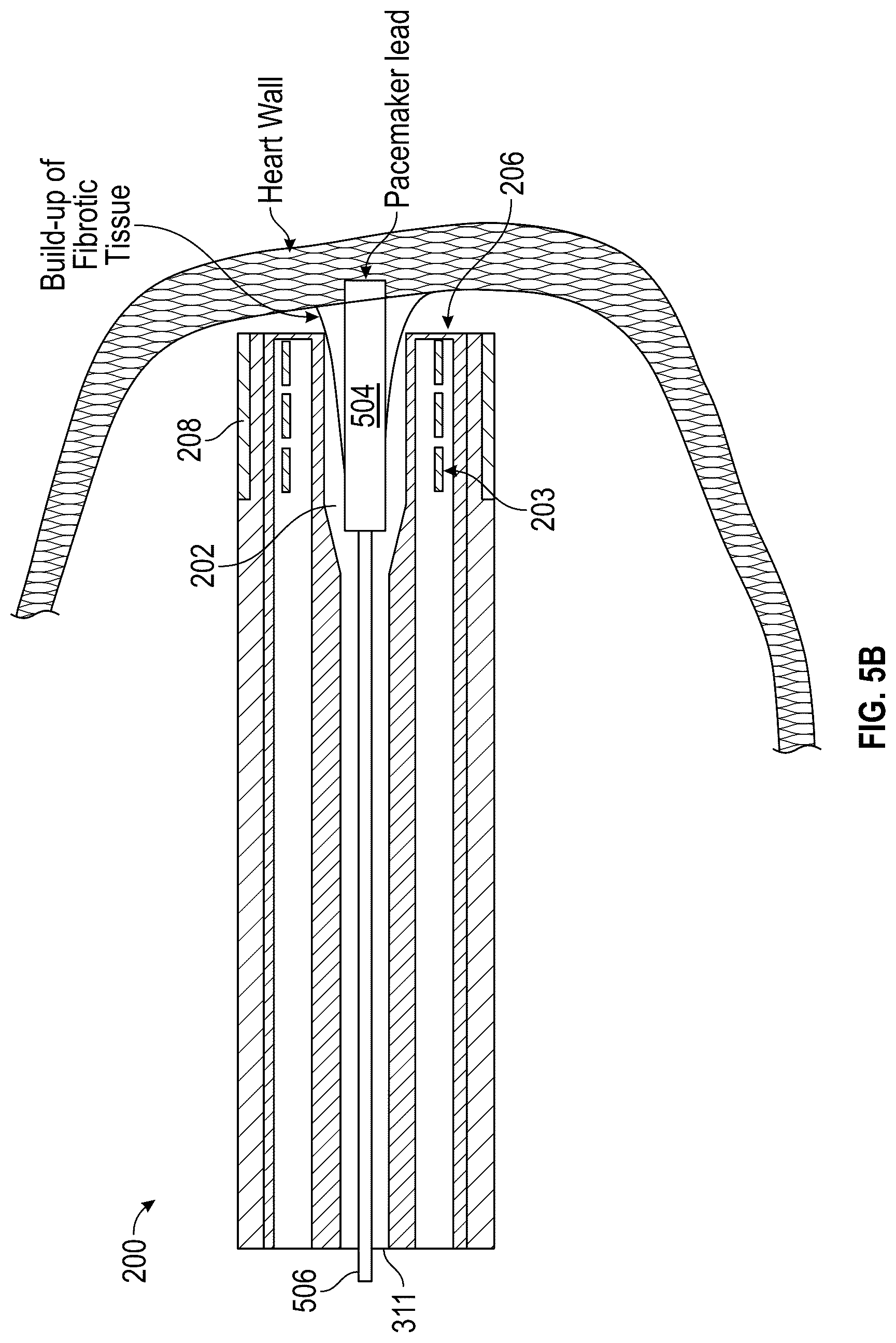 Patent US12616490 Figure 9 – Systems, devices, and methods for treatment of target material in a body lumen with shock waves