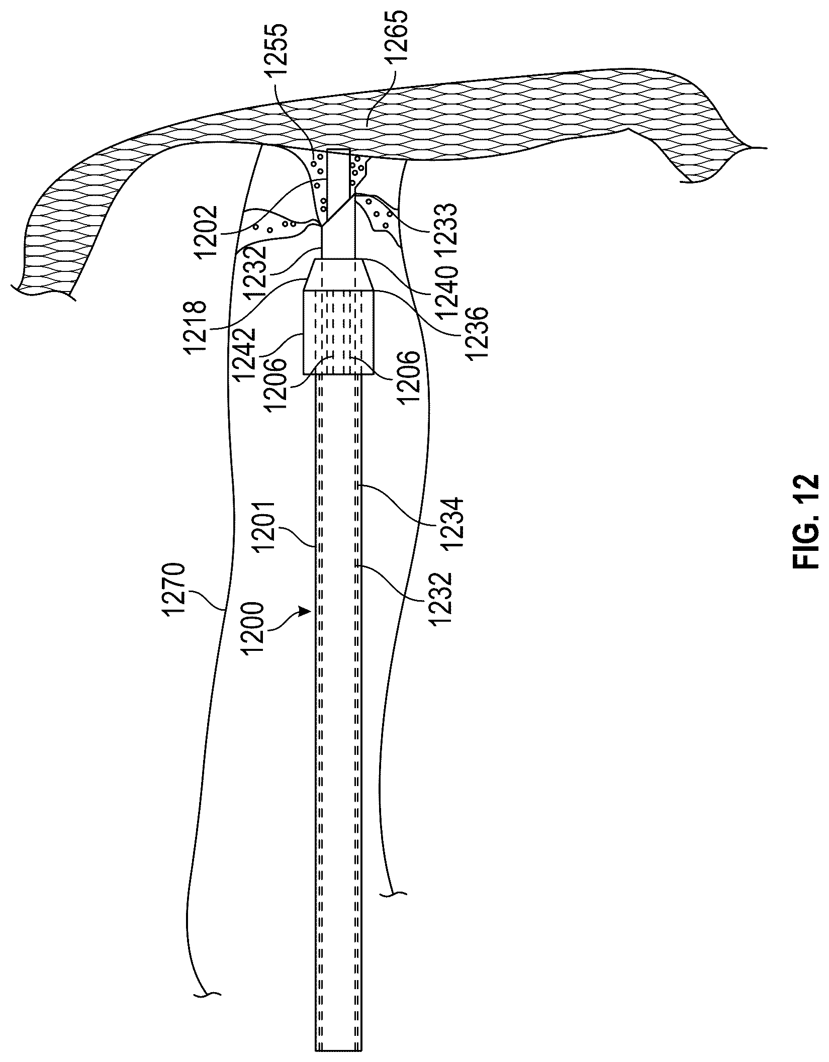 Patent US12616490 Figure 16 – Systems, devices, and methods for treatment of target material in a body lumen with shock waves