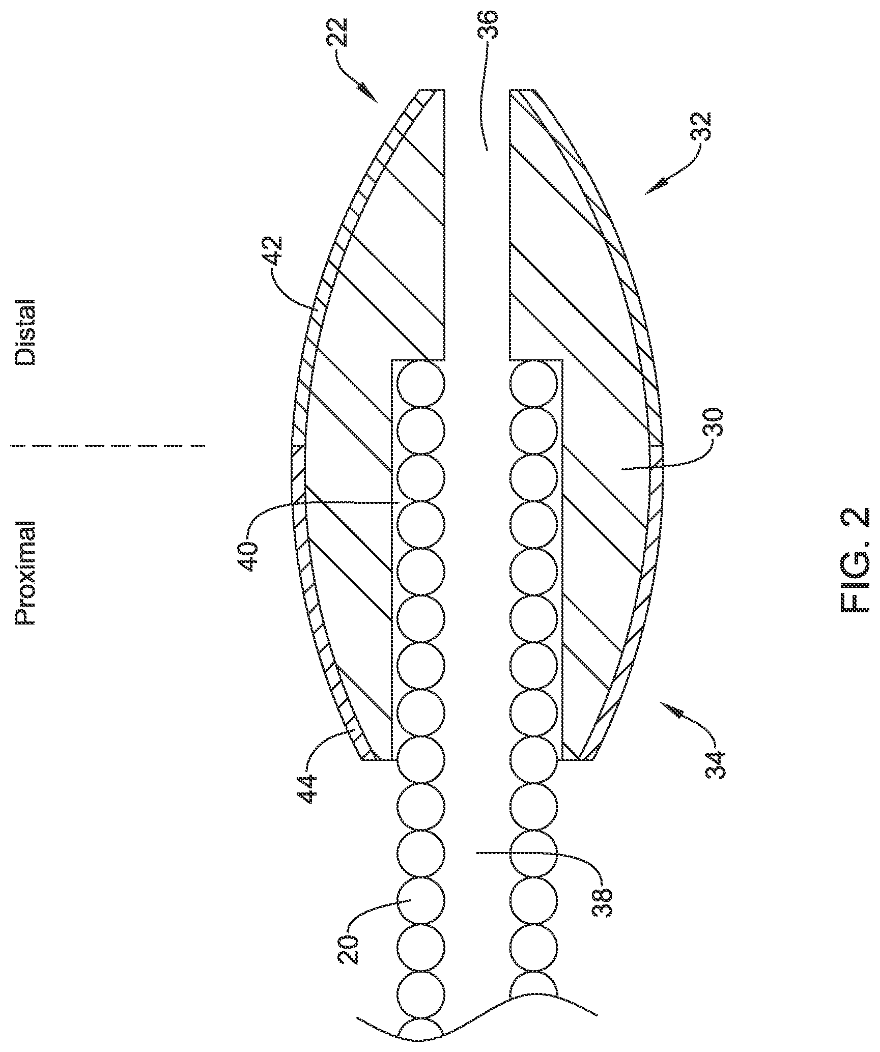 Patent US12616496 Figure 2 – Atherectomy system with anterograde and retrograde ablation