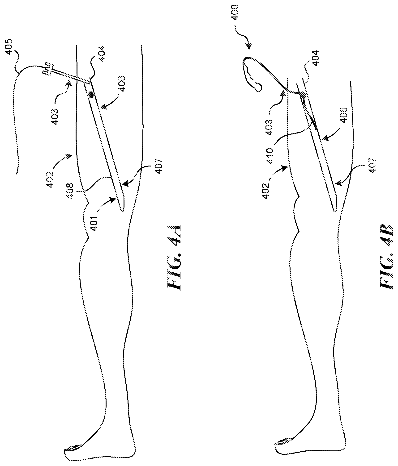 Patent US12616499 Figure 3 – Systems and methods for endoluminal valve creation