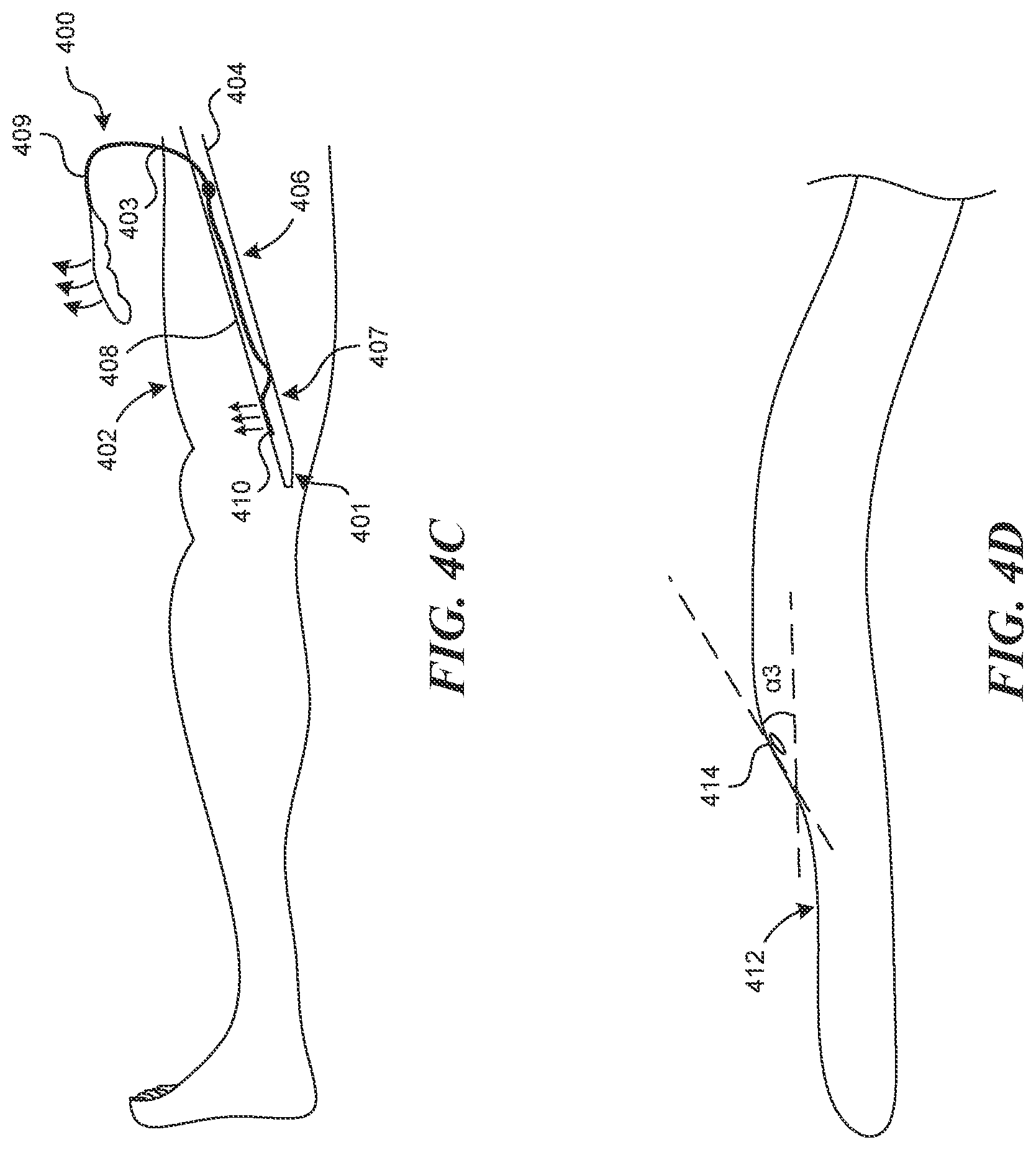 Patent US12616499 Figure 4 – Systems and methods for endoluminal valve creation