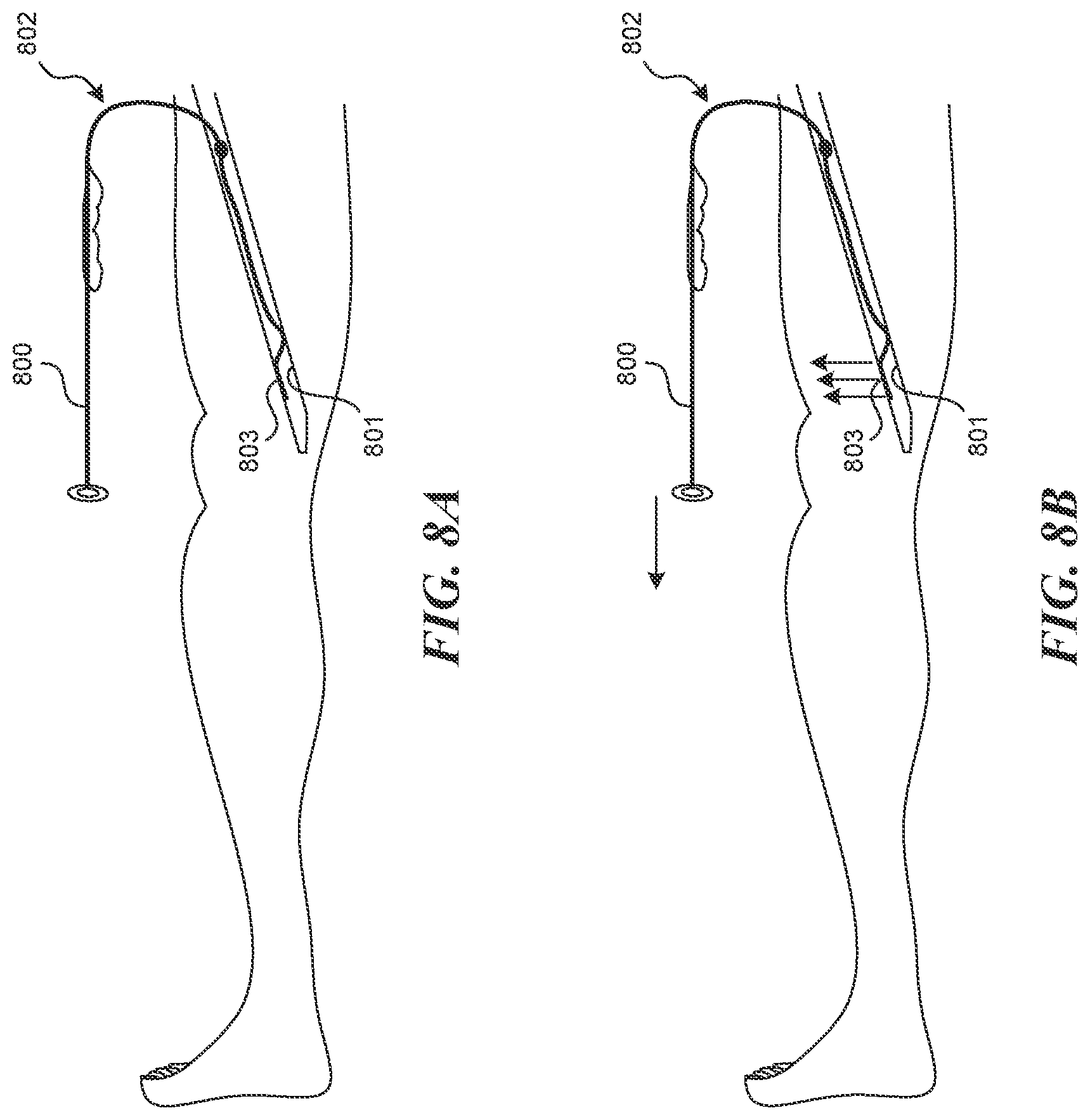 Patent US12616499 Figure 7 – Systems and methods for endoluminal valve creation
