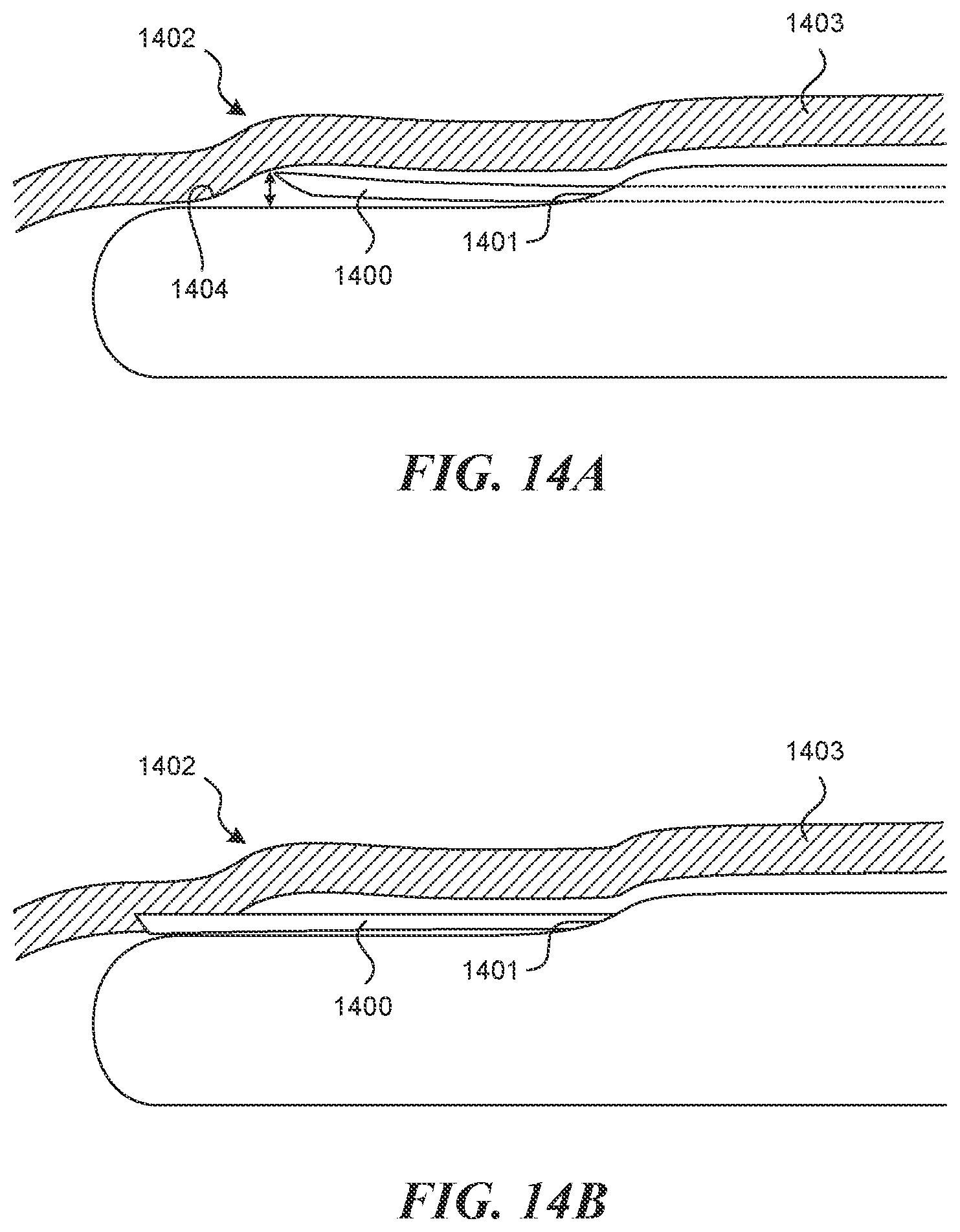 Patent US12616499 Figure 12 – Systems and methods for endoluminal valve creation