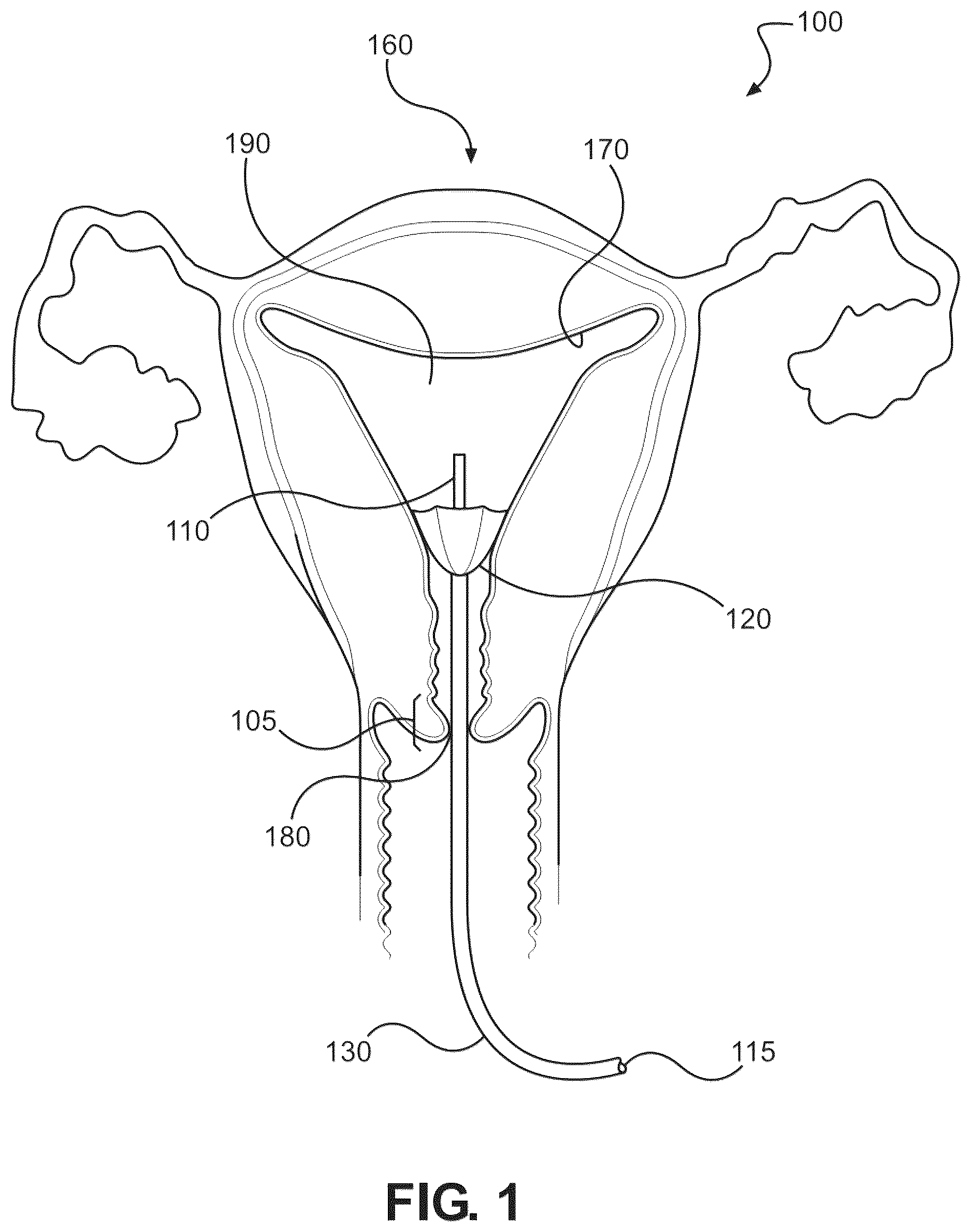 Patent US12616503 Figure 1 – Methods for postpartum uterine hemostasis