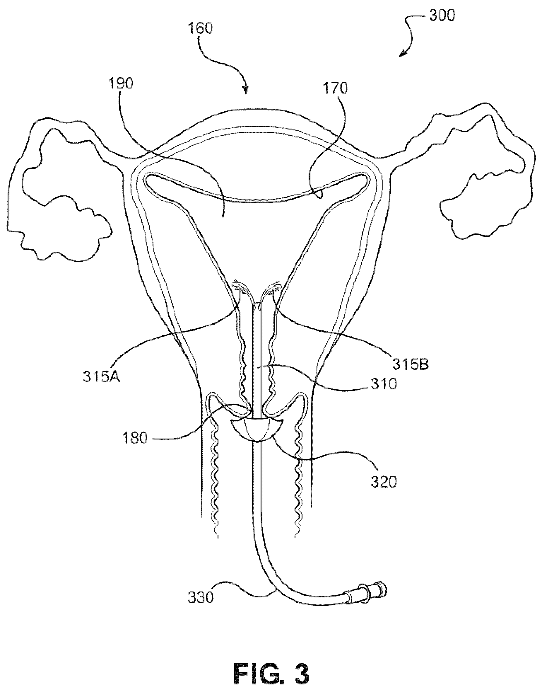 Patent US12616503 Figure 3 – Methods for postpartum uterine hemostasis