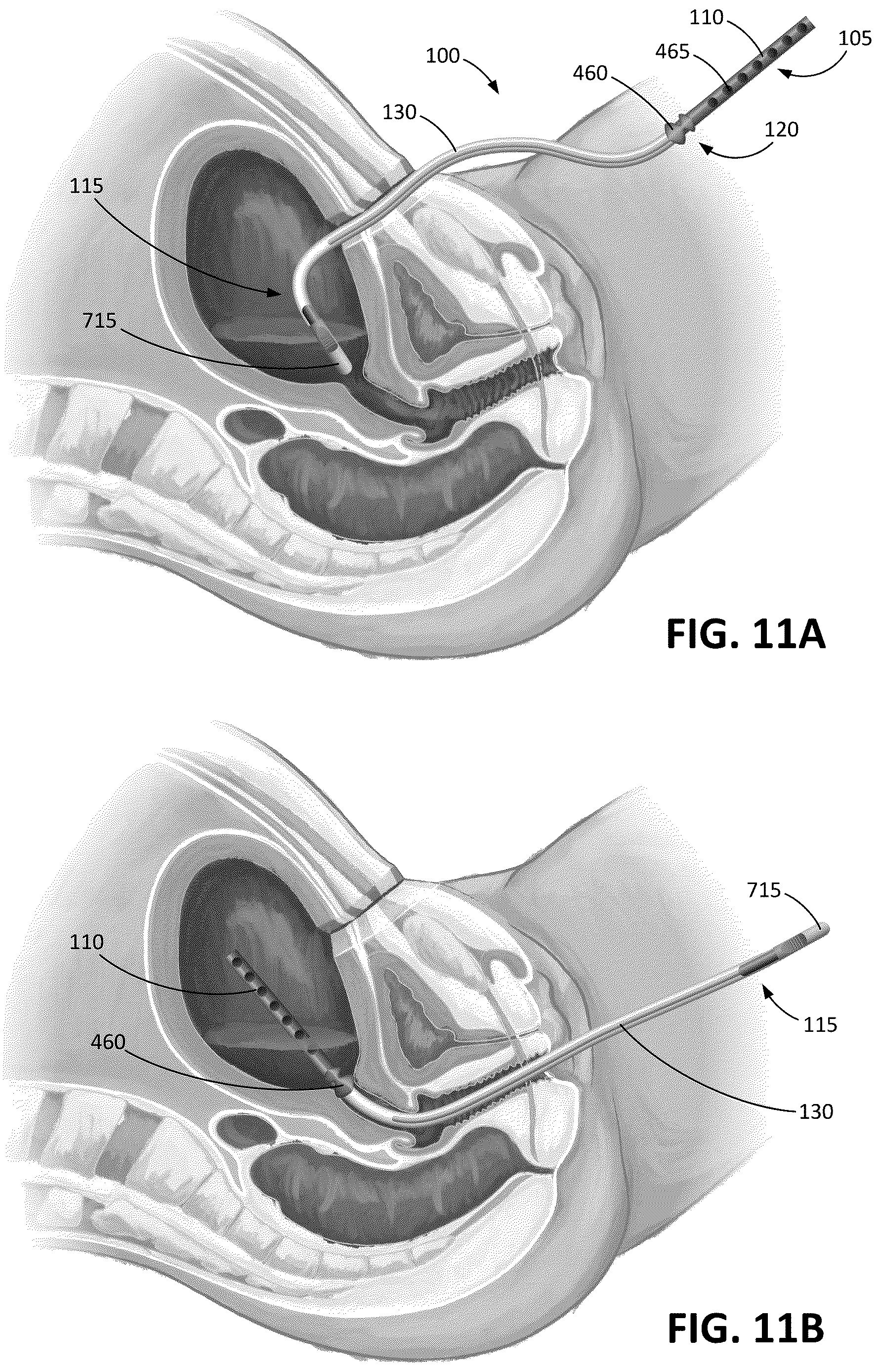 Patent US12616503 Figure 11 – Methods for postpartum uterine hemostasis