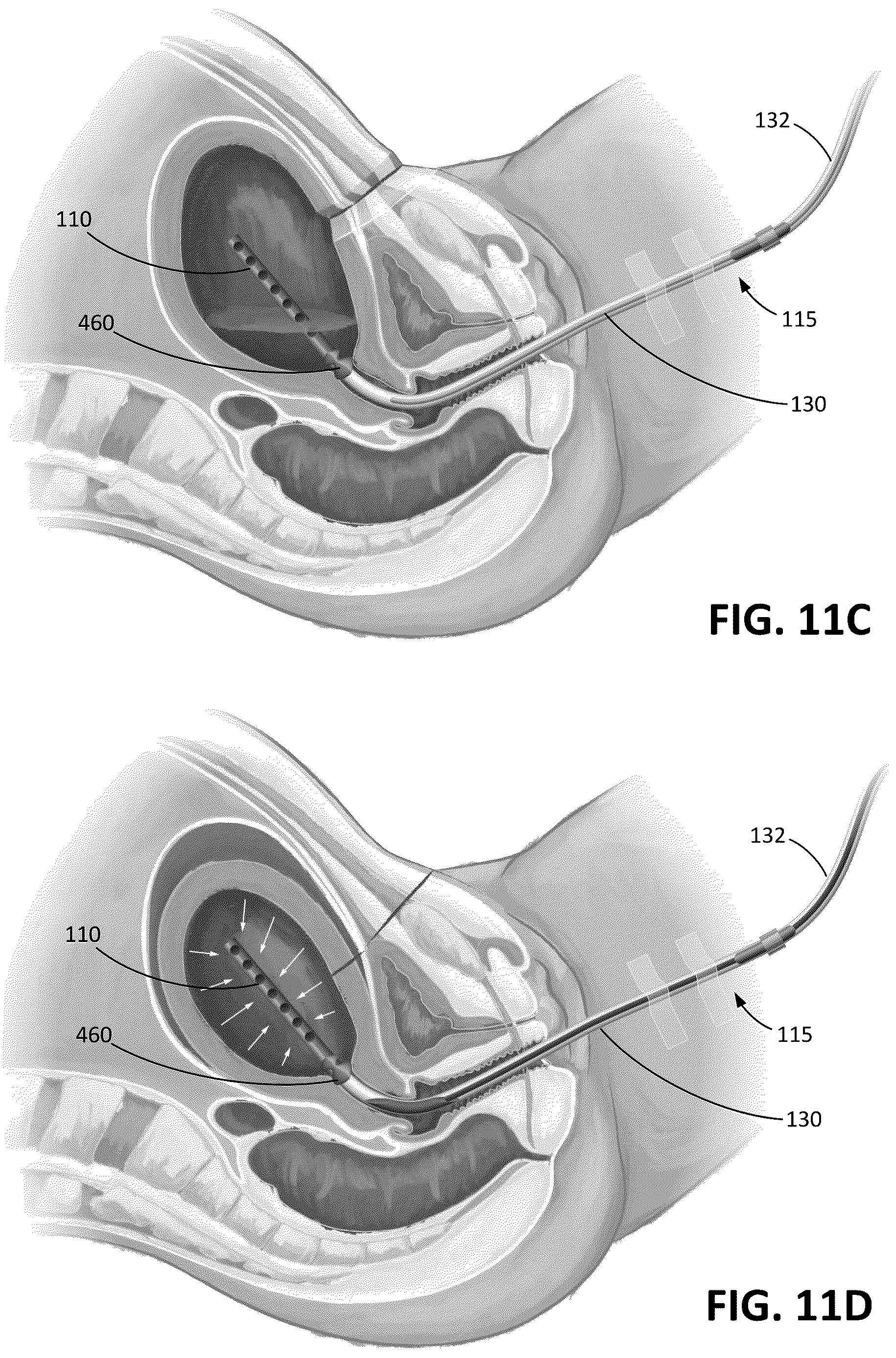 Patent US12616503 Figure 12 – Methods for postpartum uterine hemostasis