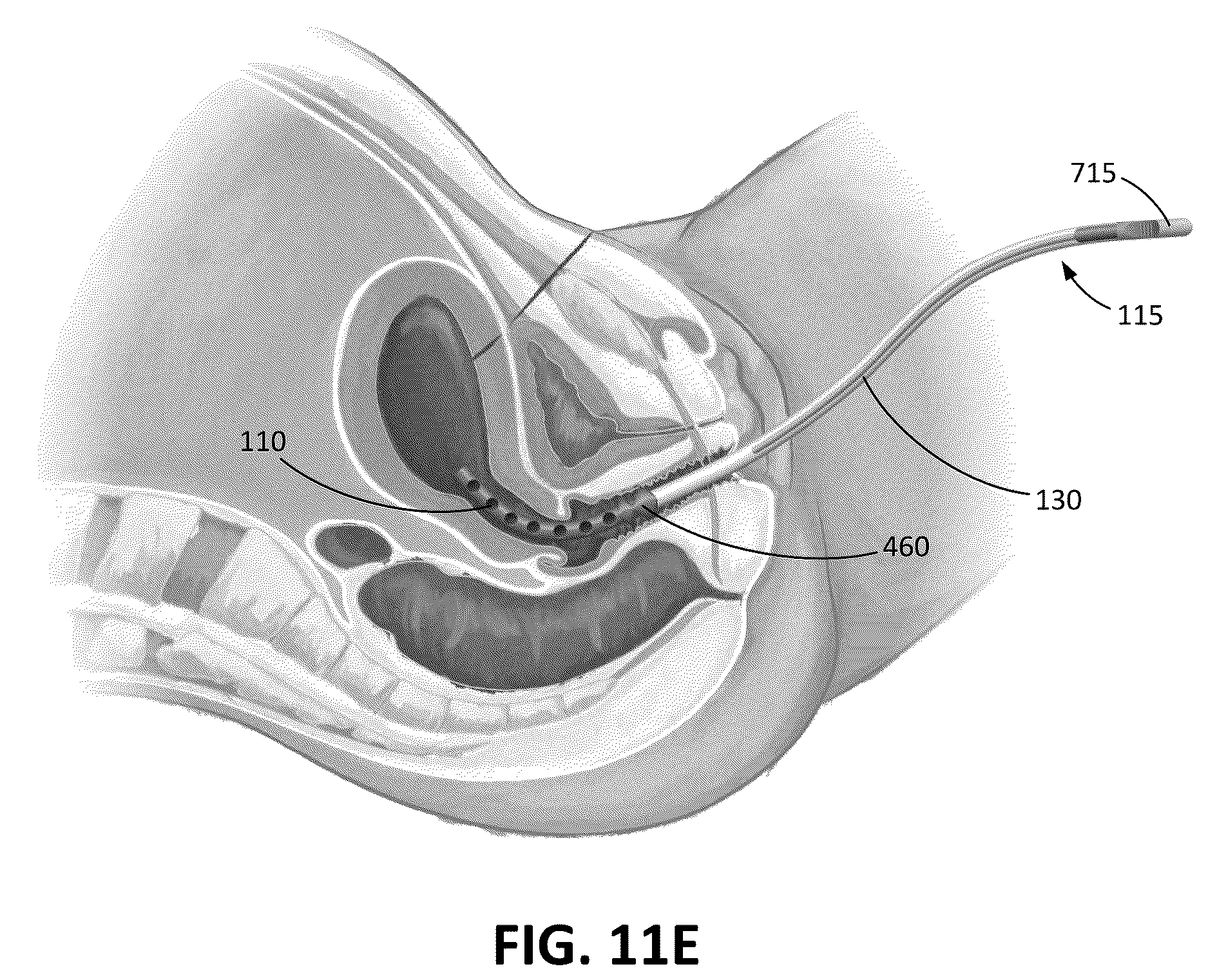 Patent US12616503 Figure 13 – Methods for postpartum uterine hemostasis