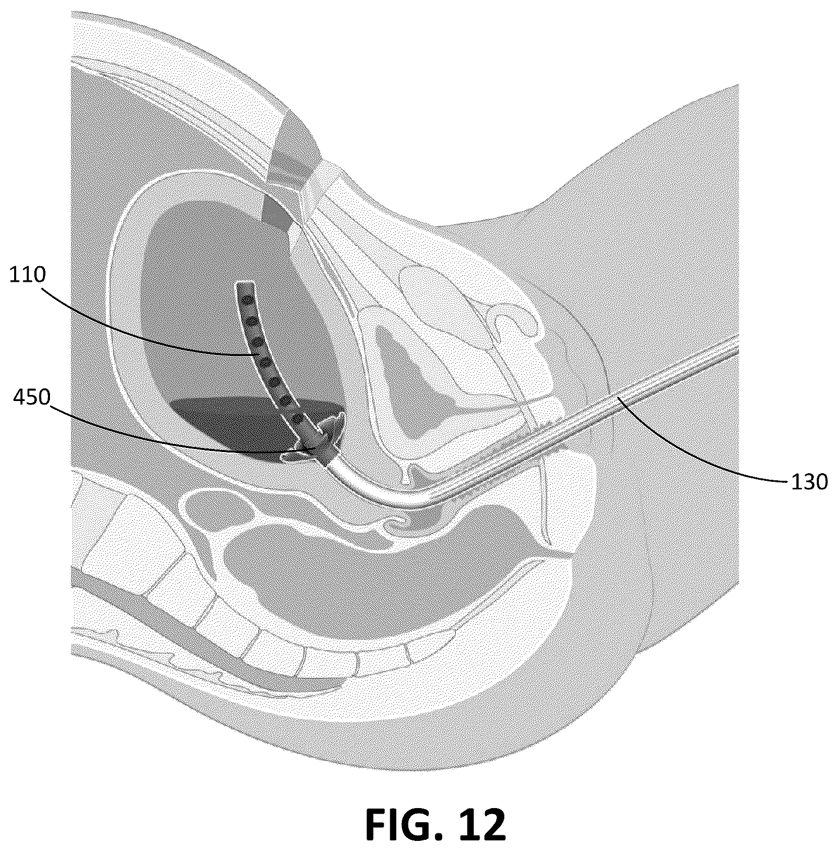 Patent US12616503 Figure 14 – Methods for postpartum uterine hemostasis