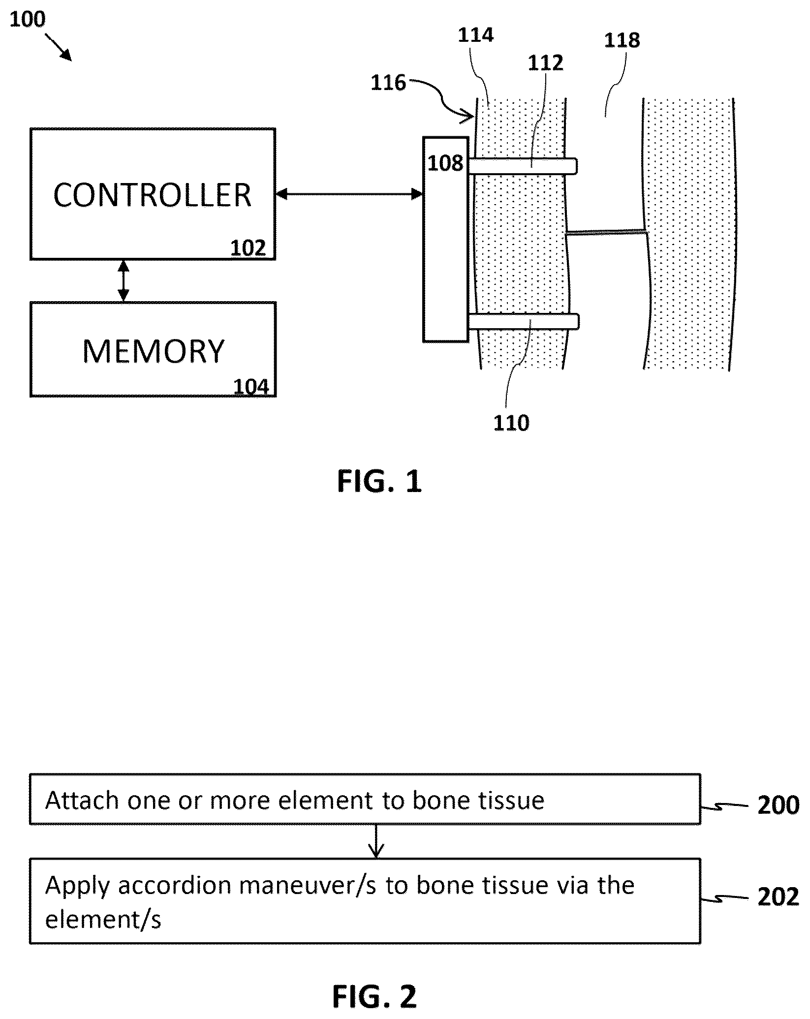 Patent US12616505 Figure 1 – Accordion maneuver with a bone fixation device