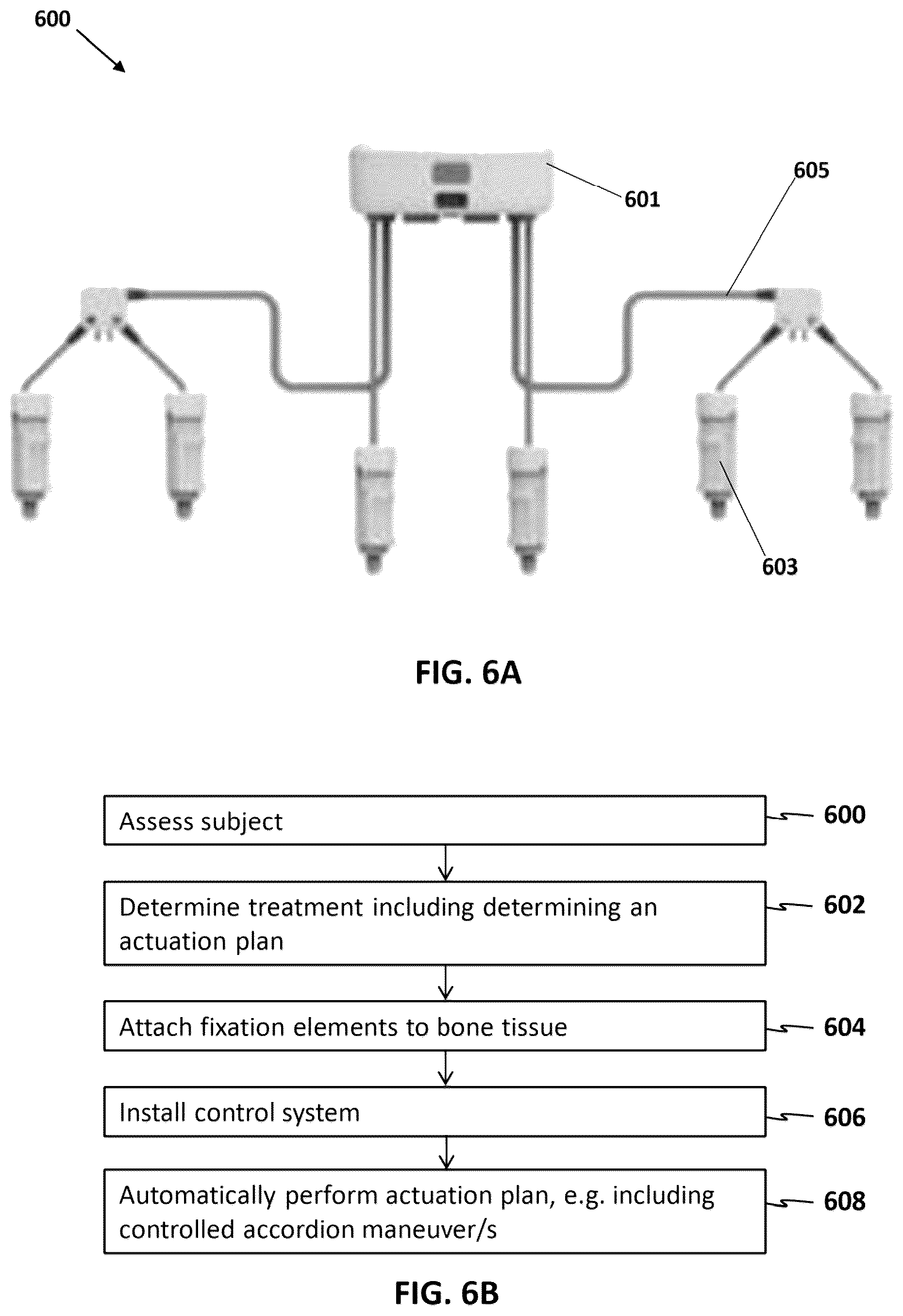 Patent US12616505 Figure 5 – Accordion maneuver with a bone fixation device