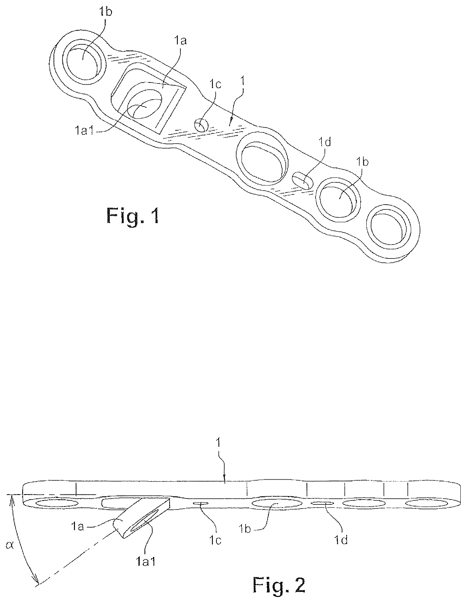 Patent US12616507 — Orthopedic implant in the form of a plate to be fixed between two bone parts — Figure 1
