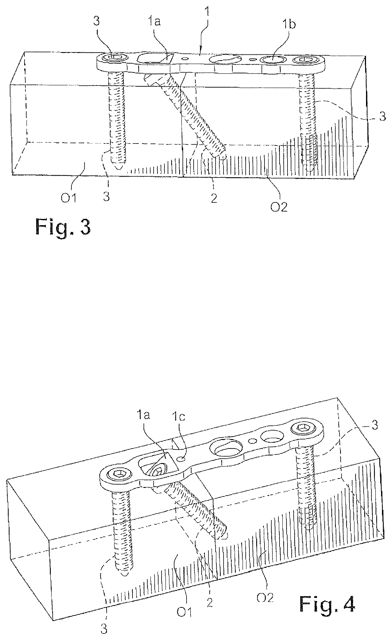 Patent US12616507 Figure 2 – Orthopedic implant in the form of a plate to be fixed between two bone parts
