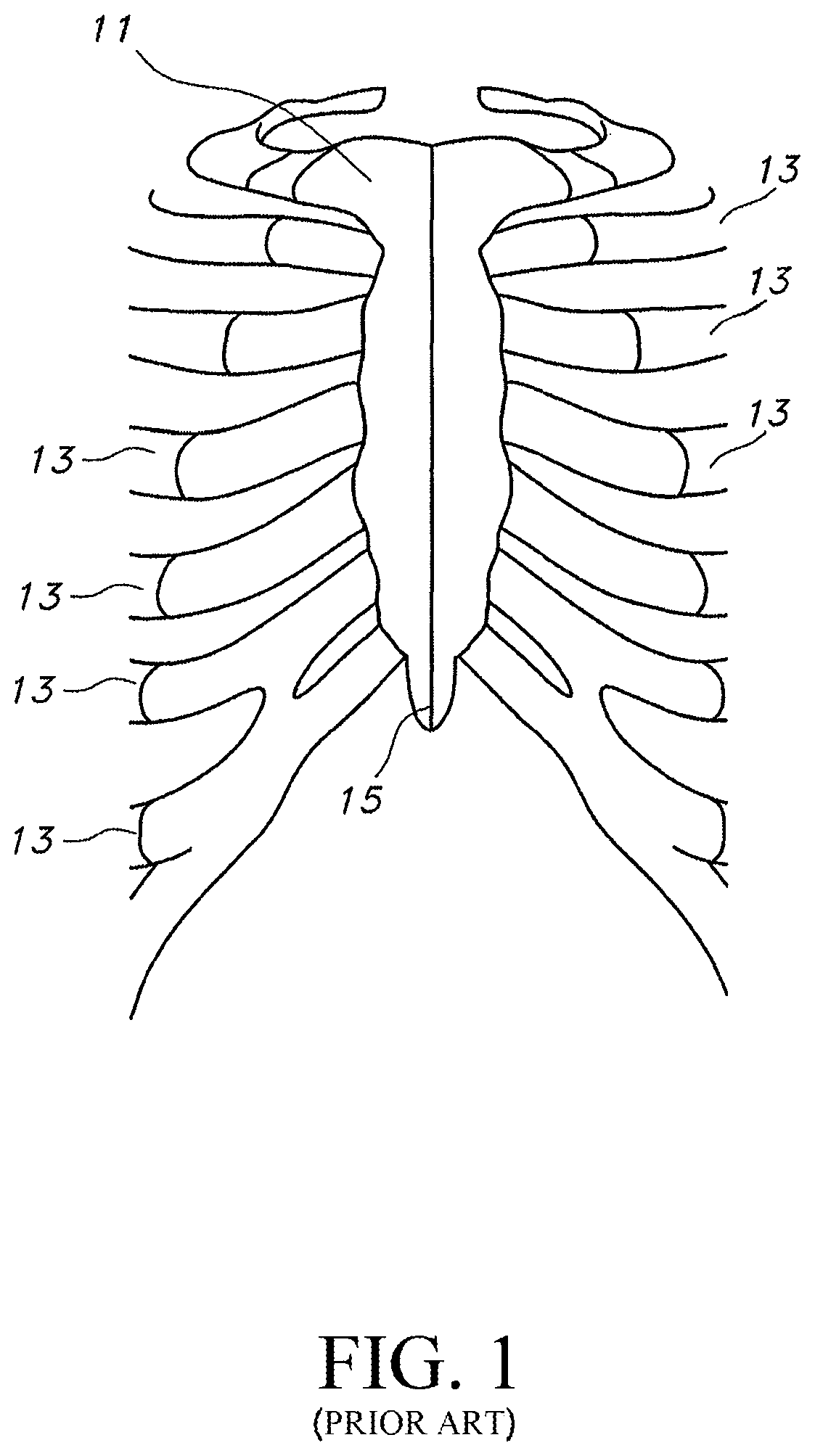 Patent US12616509 Figure 1 – Sternum fixation device and method