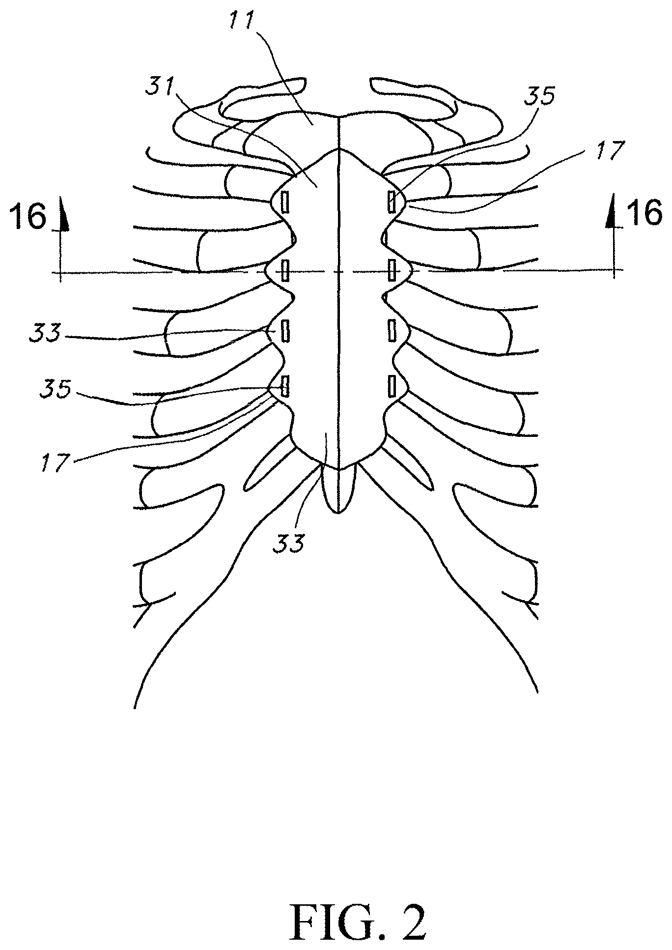 Patent US12616509 Figure 2 – Sternum fixation device and method