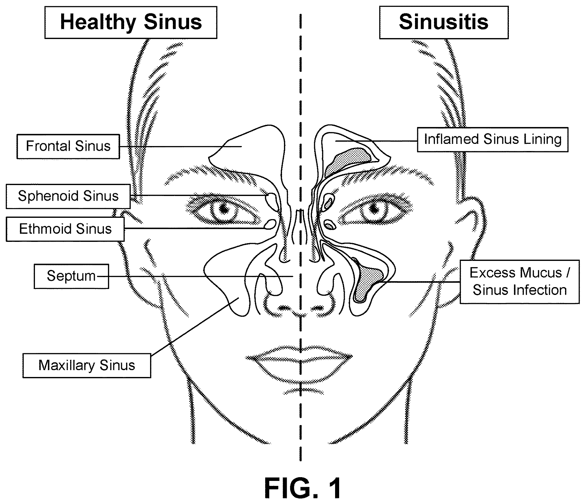 Patent US12616514 Figure 1 – Systems and methods for treating chronic sinusitis
