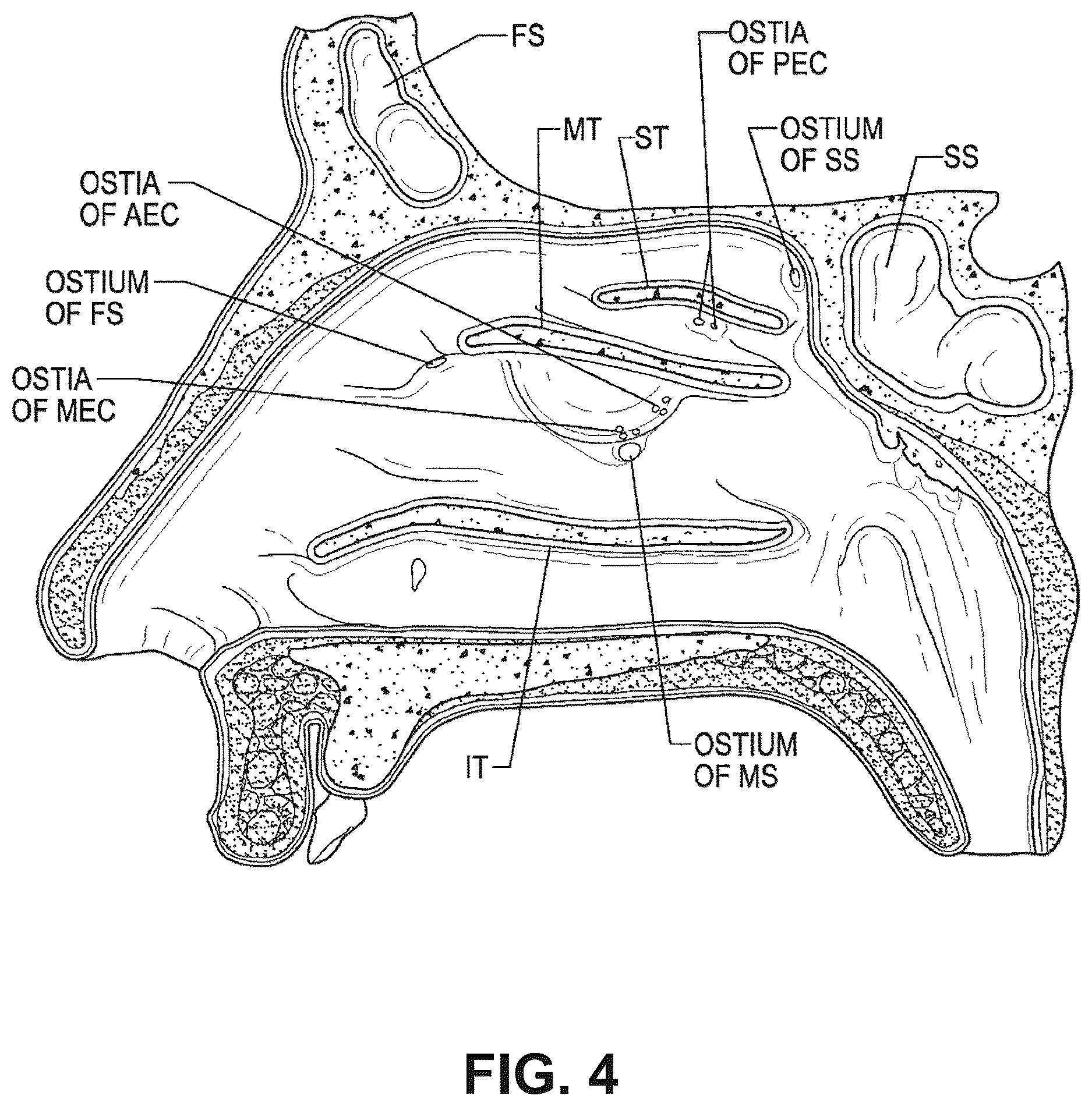 Patent US12616514 Figure 4 – Systems and methods for treating chronic sinusitis