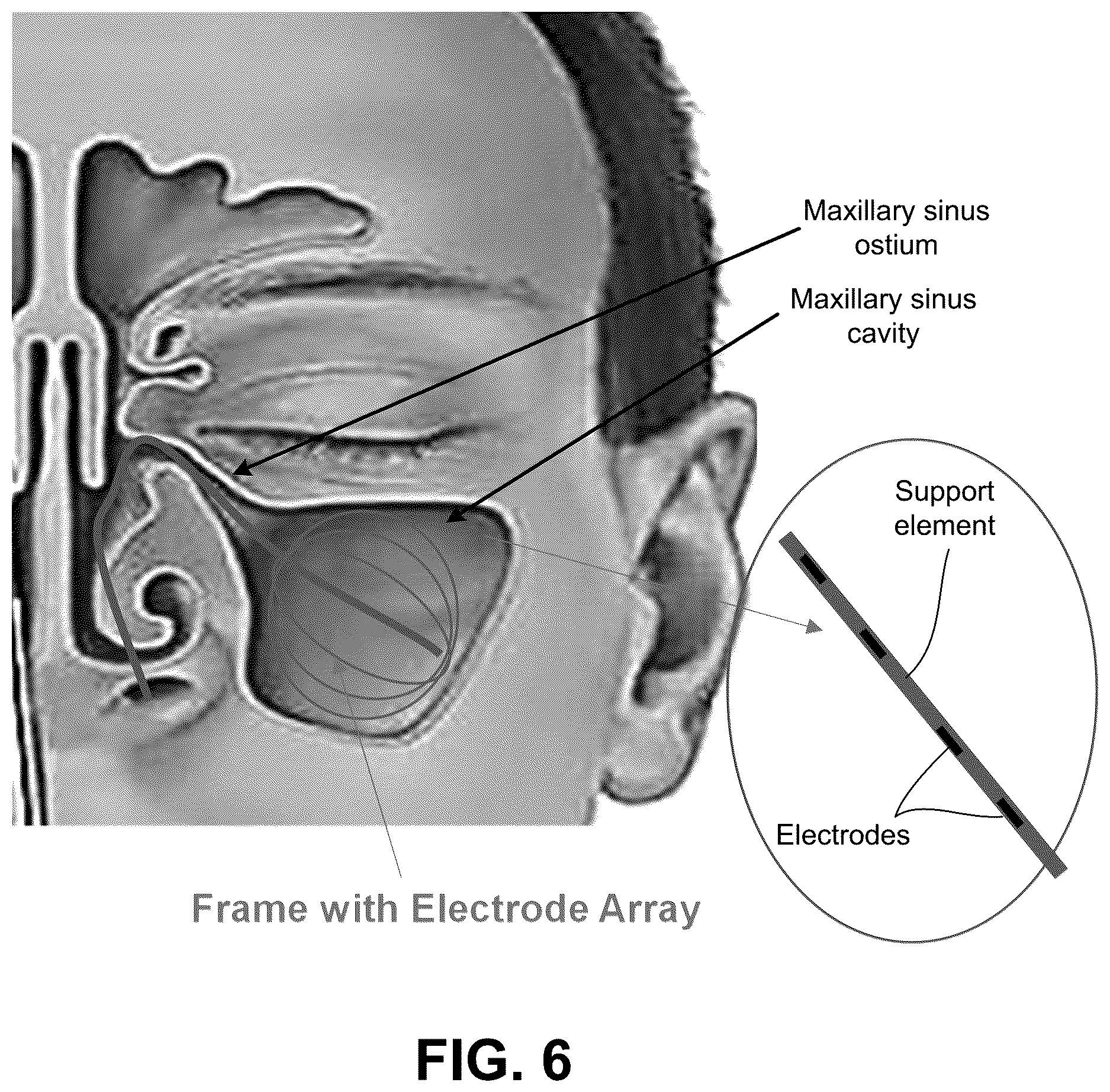 Patent US12616514 Figure 6 – Systems and methods for treating chronic sinusitis