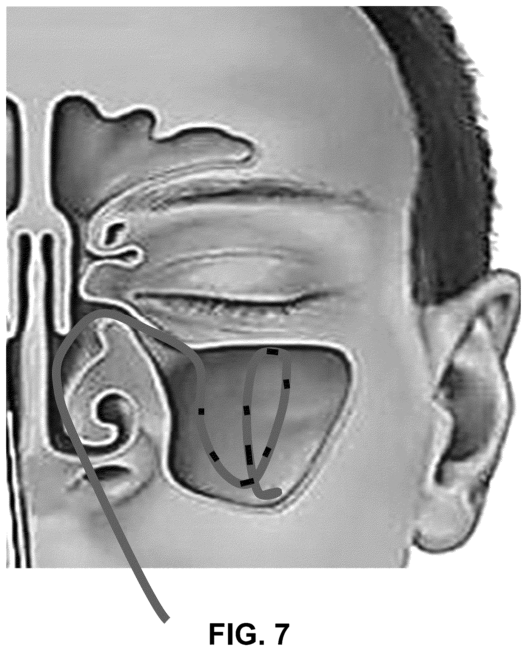 Patent US12616514 Figure 7 – Systems and methods for treating chronic sinusitis