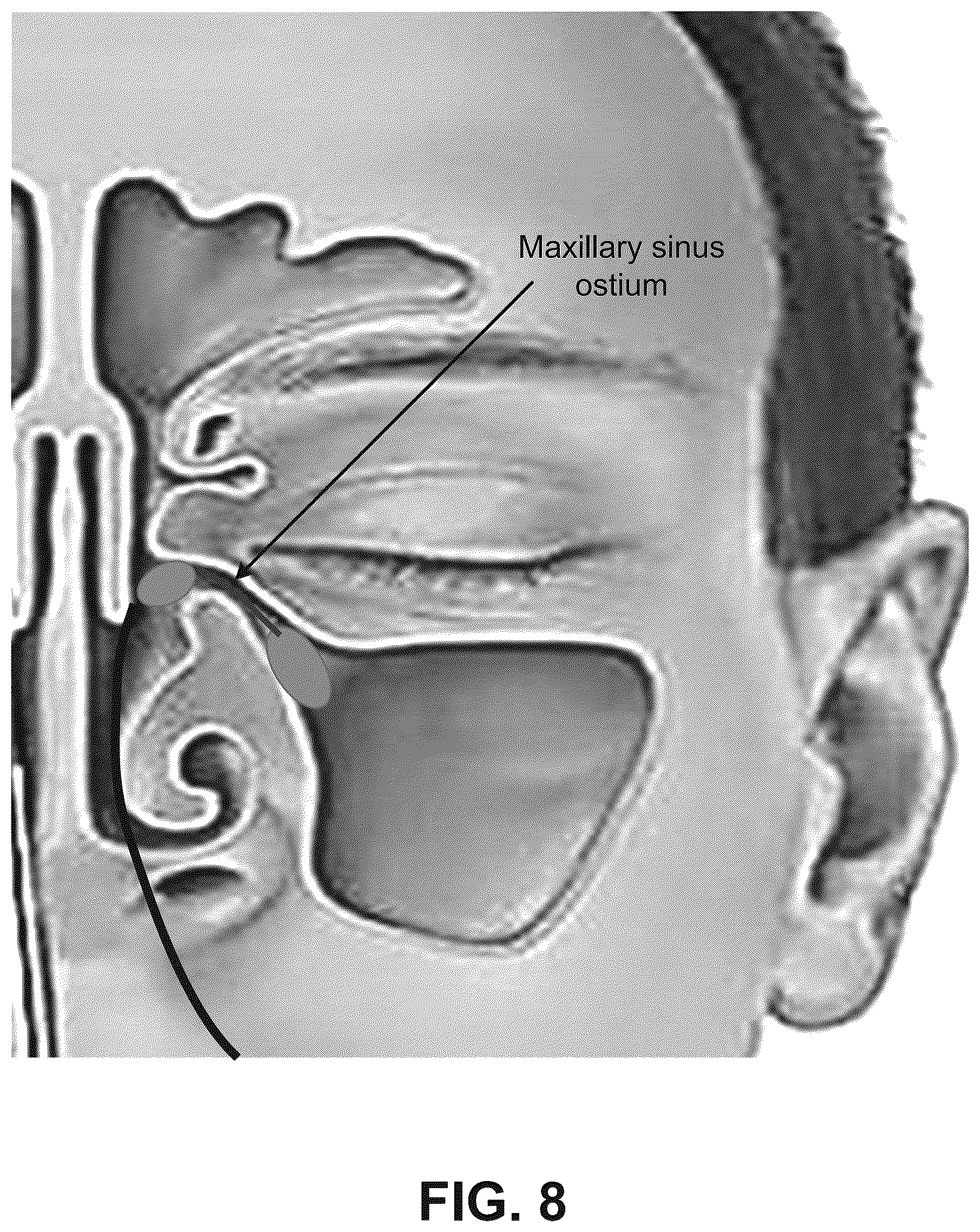 Patent US12616514 Figure 8 – Systems and methods for treating chronic sinusitis