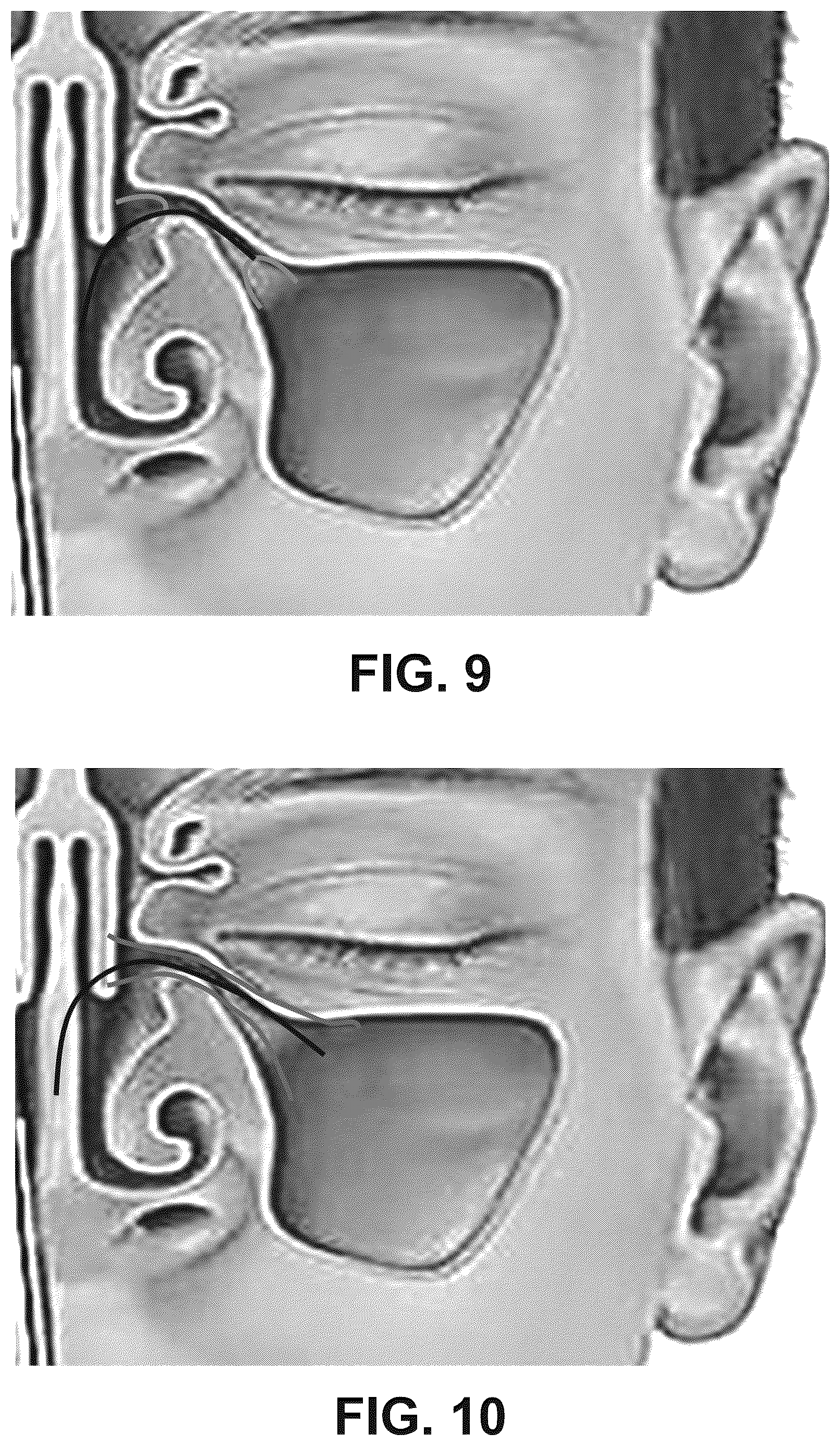 Patent US12616514 Figure 9 – Systems and methods for treating chronic sinusitis