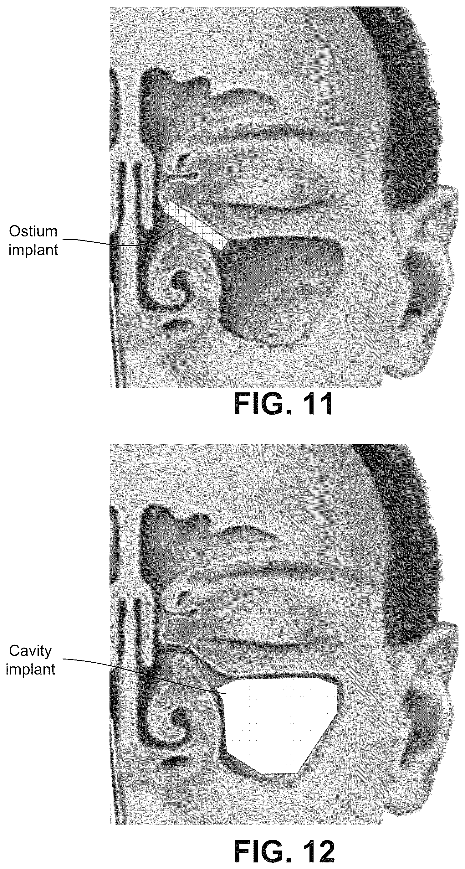 Patent US12616514 Figure 10 – Systems and methods for treating chronic sinusitis