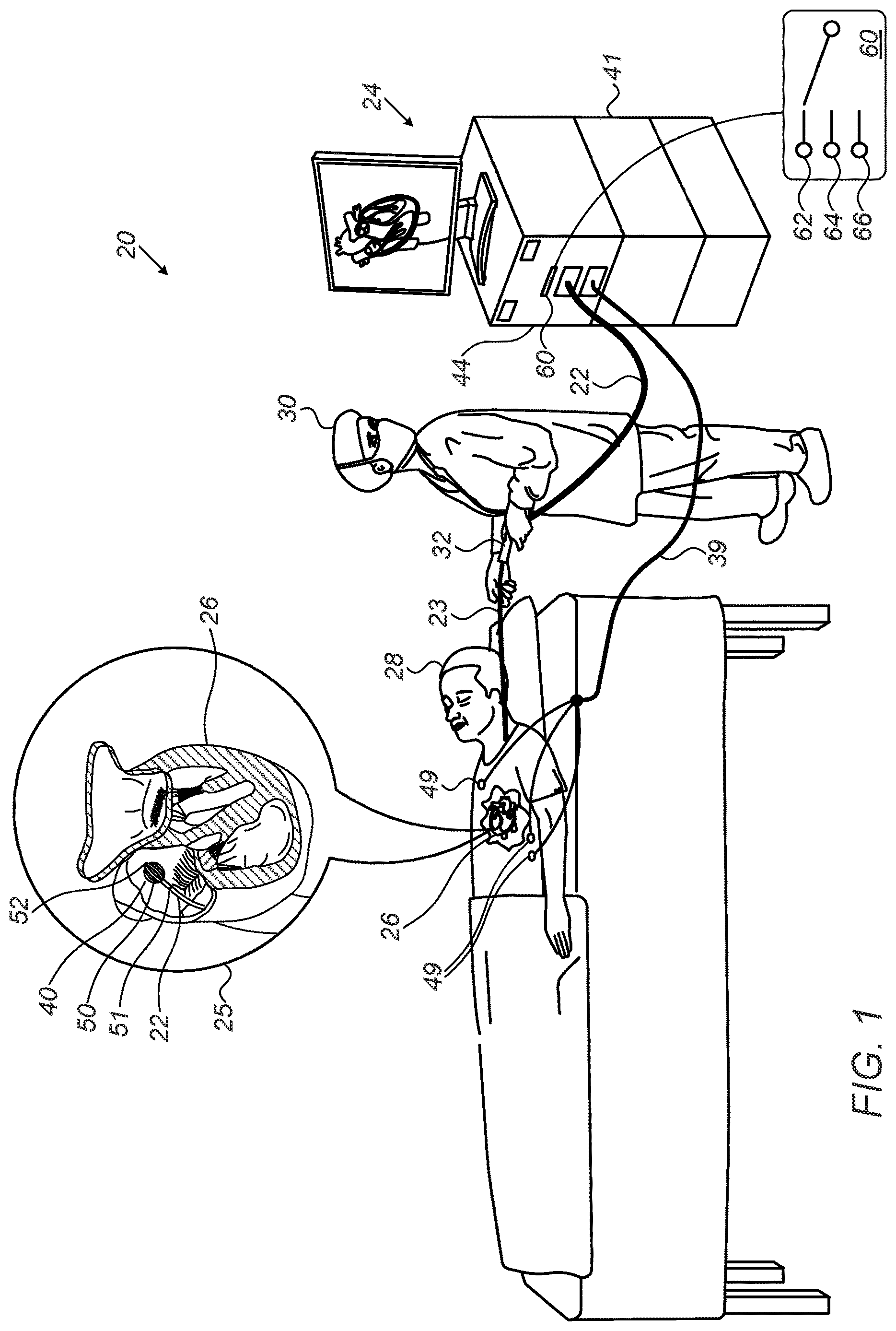 Patent US12616515 Figure 1 – Estimation of electrode-tissue contact using stem and edge electrodes