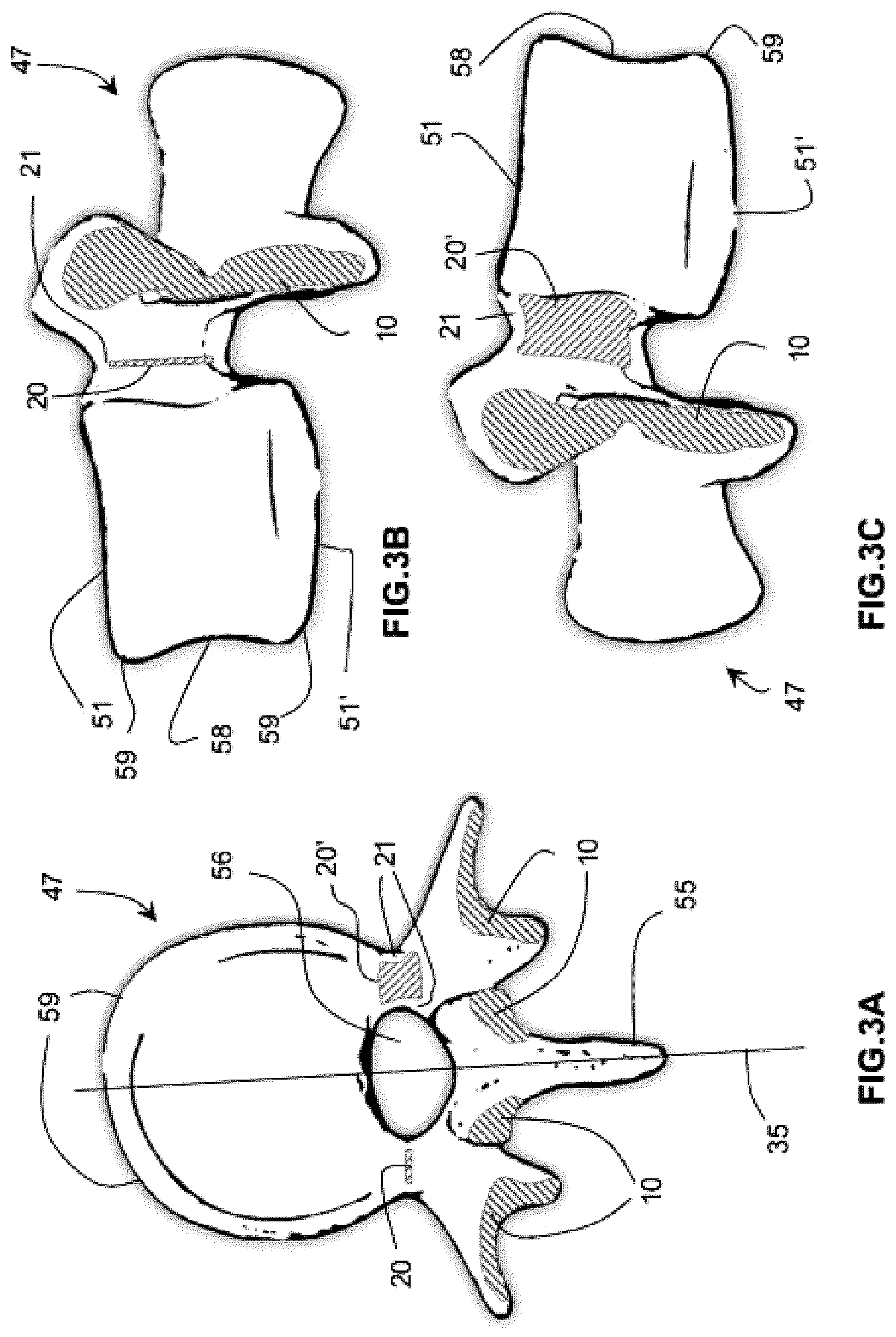 Patent US12616522 Figure 3 – Method for determining the screw trajectory of a pedicle bone screw