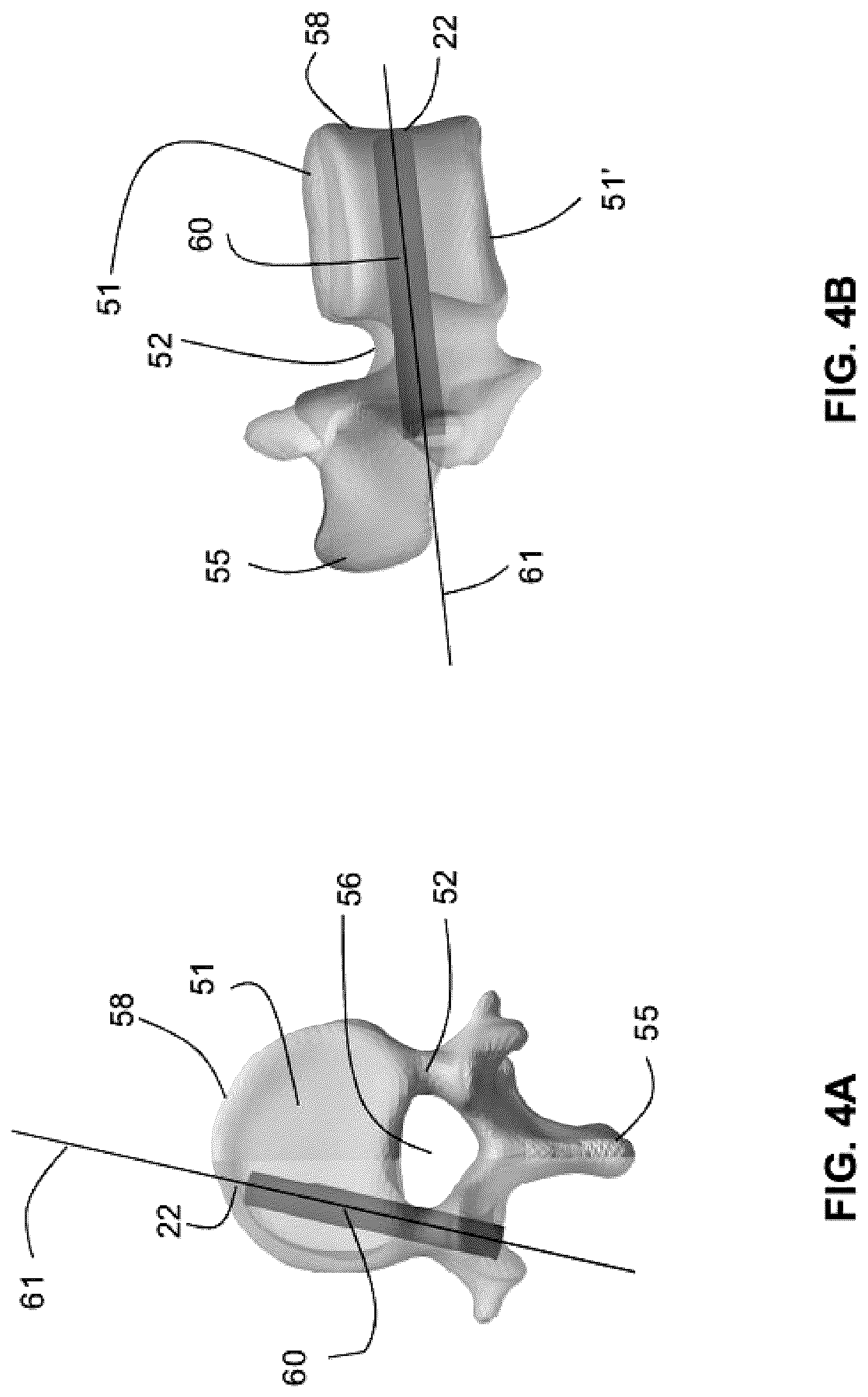 Patent US12616522 Figure 4 – Method for determining the screw trajectory of a pedicle bone screw