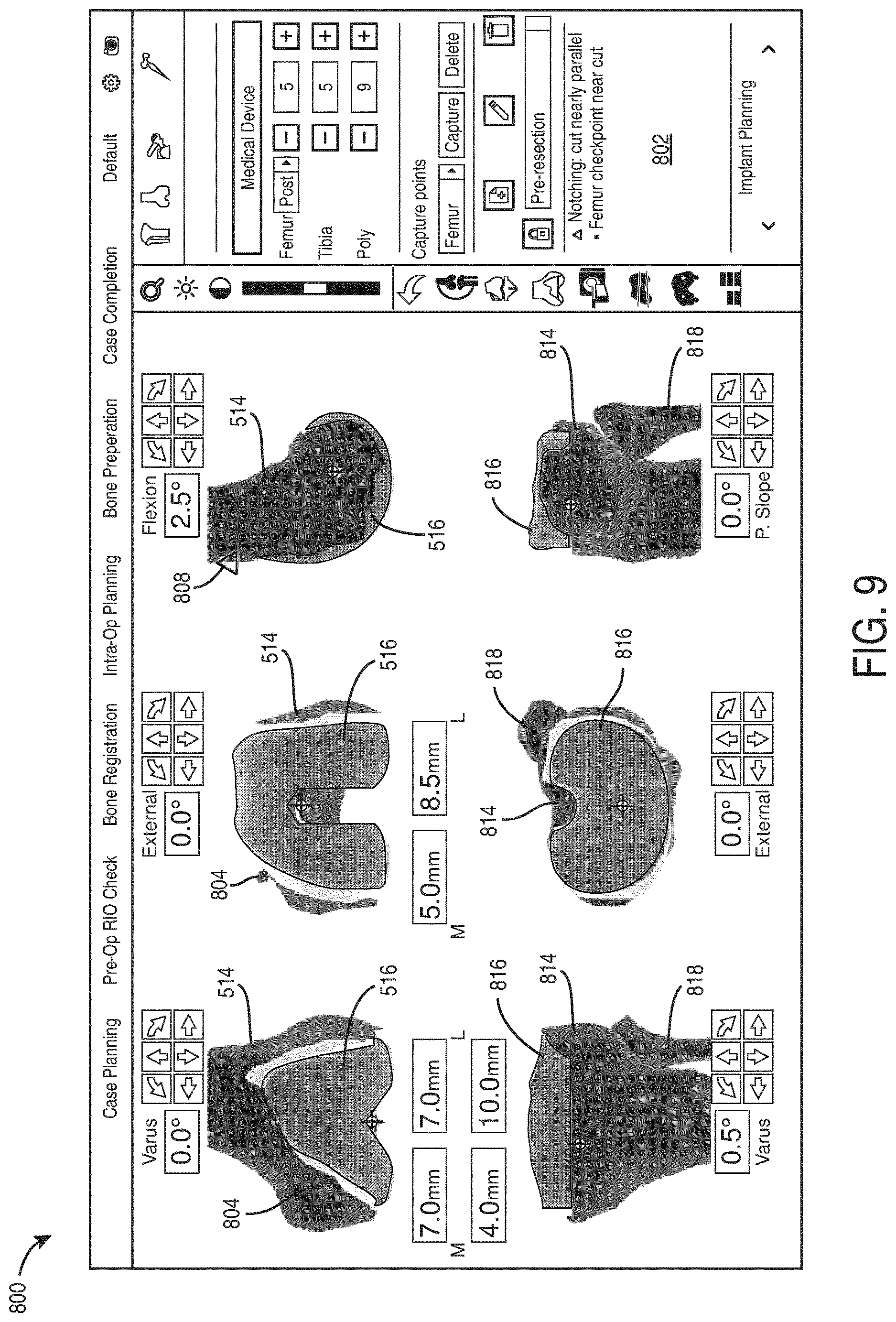 Patent US12616523 Figure 9 – Surgeon preferences and warning visualizations for implant planning