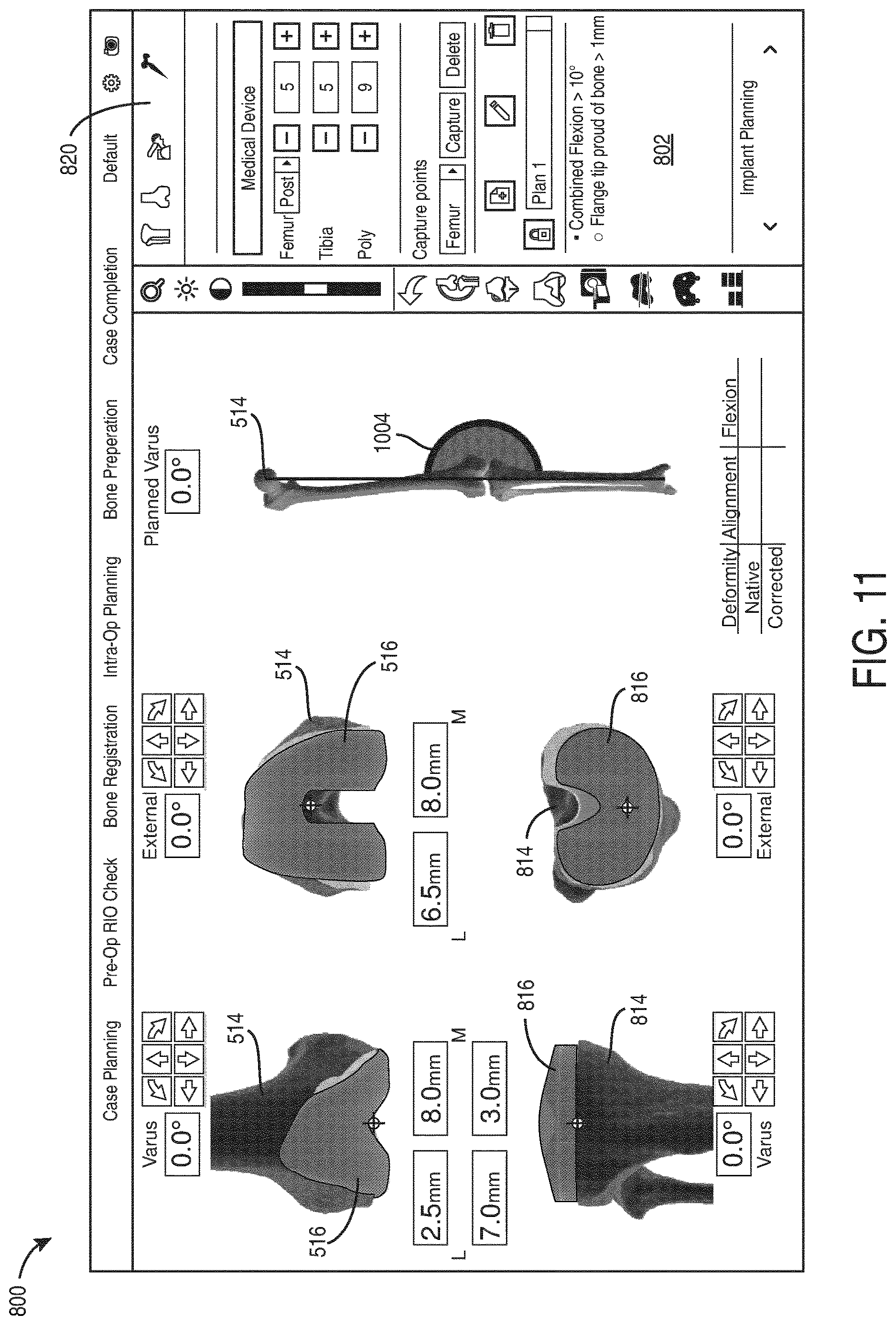 Patent US12616523 Figure 11 – Surgeon preferences and warning visualizations for implant planning