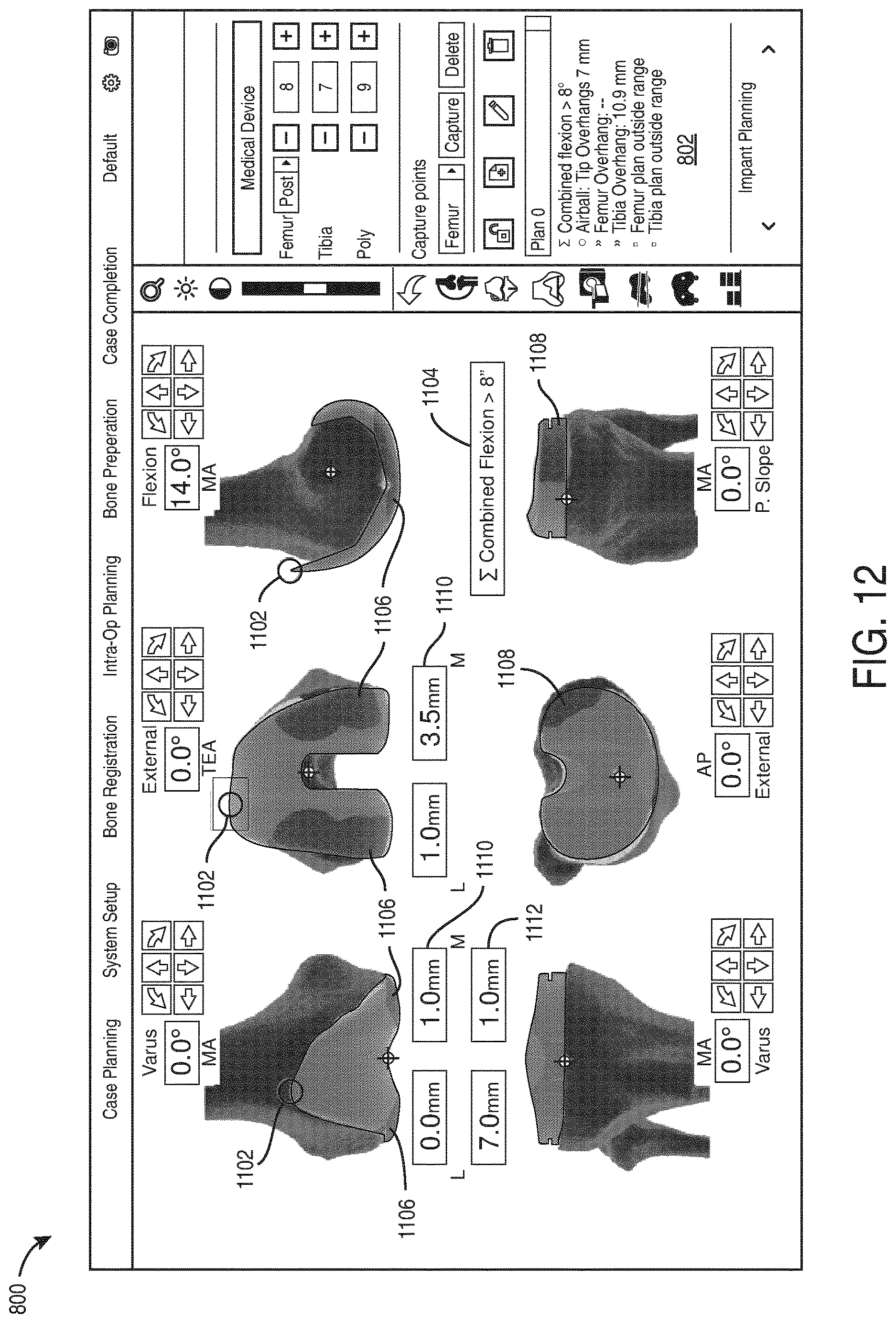 Patent US12616523 Figure 12 – Surgeon preferences and warning visualizations for implant planning