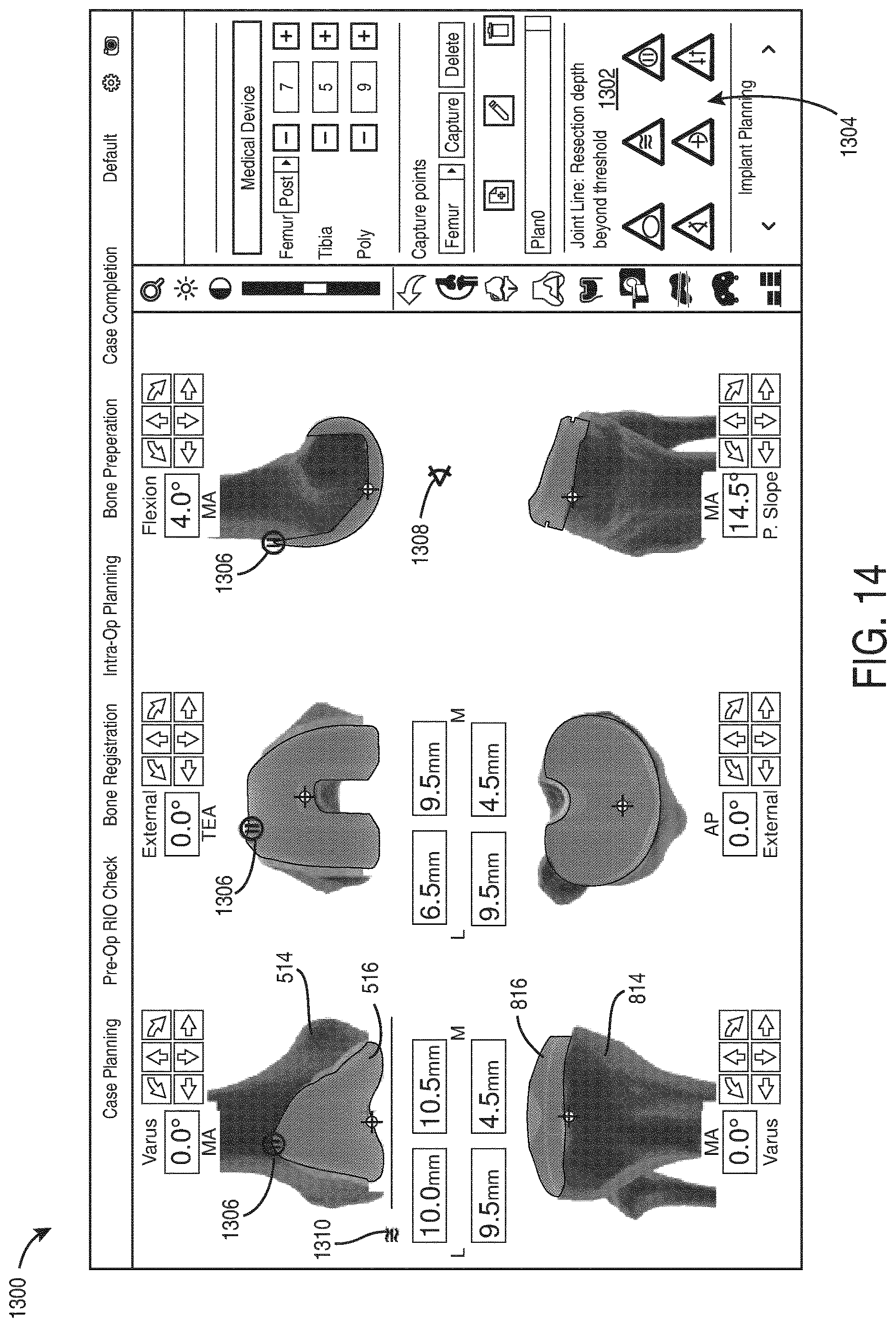 Patent US12616523 Figure 14 – Surgeon preferences and warning visualizations for implant planning