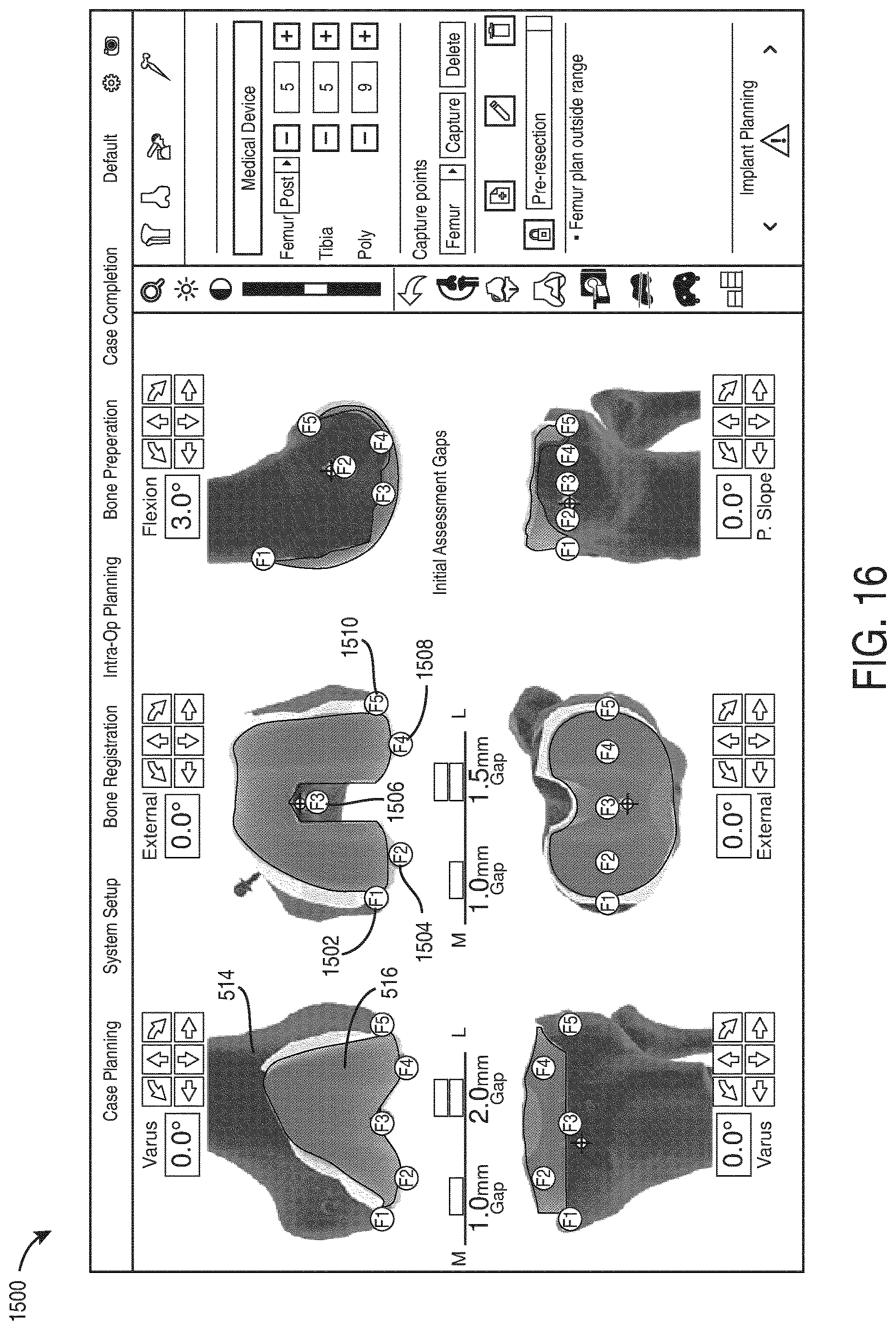 Patent US12616523 Figure 16 – Surgeon preferences and warning visualizations for implant planning