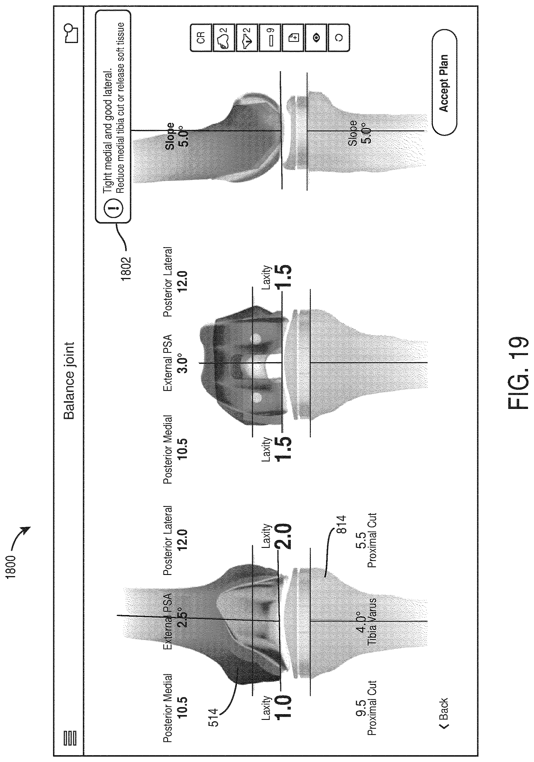 Patent US12616523 Figure 19 – Surgeon preferences and warning visualizations for implant planning