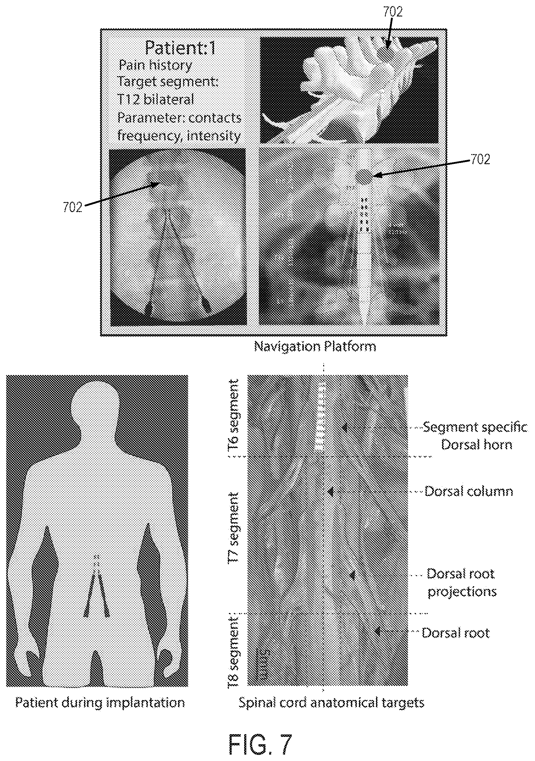 Patent US12616524 Figure 8 – Image-guided navigation system for targeted delivery of spinal cord therapies