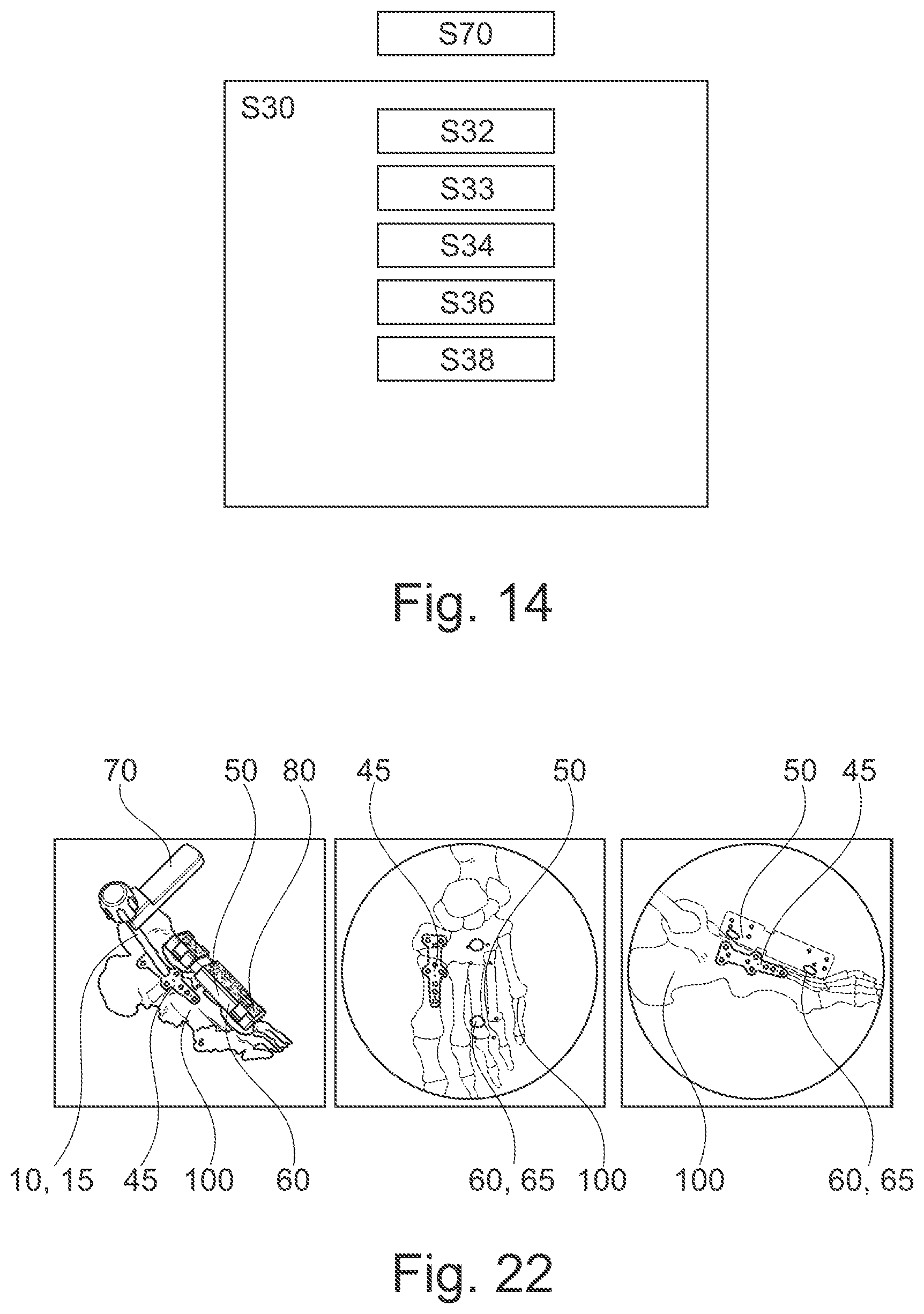 Patent US12616527 Figure 6 – Surgical tracking system for tracking an instrument with respect to a reference body