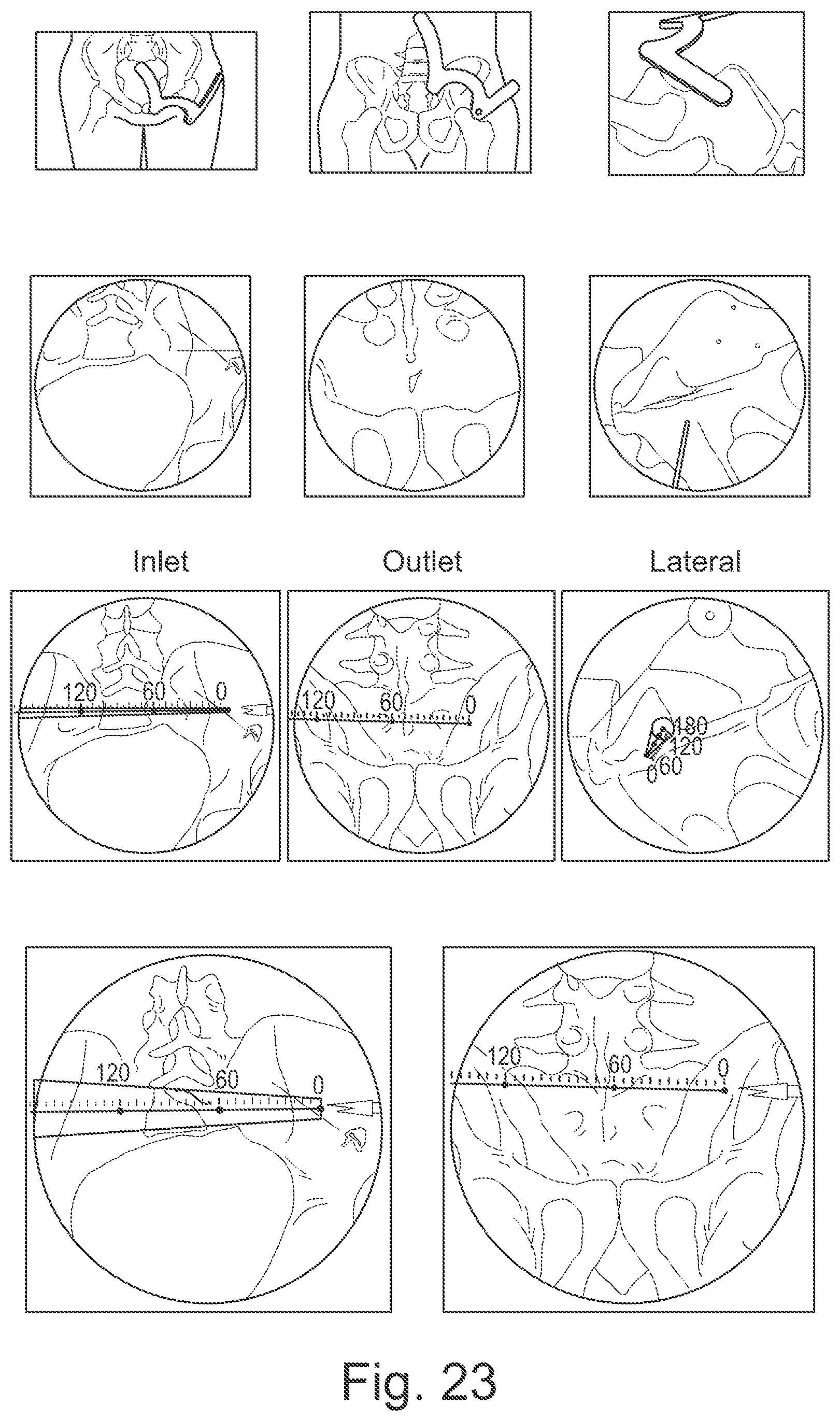 Patent US12616527 Figure 9 – Surgical tracking system for tracking an instrument with respect to a reference body