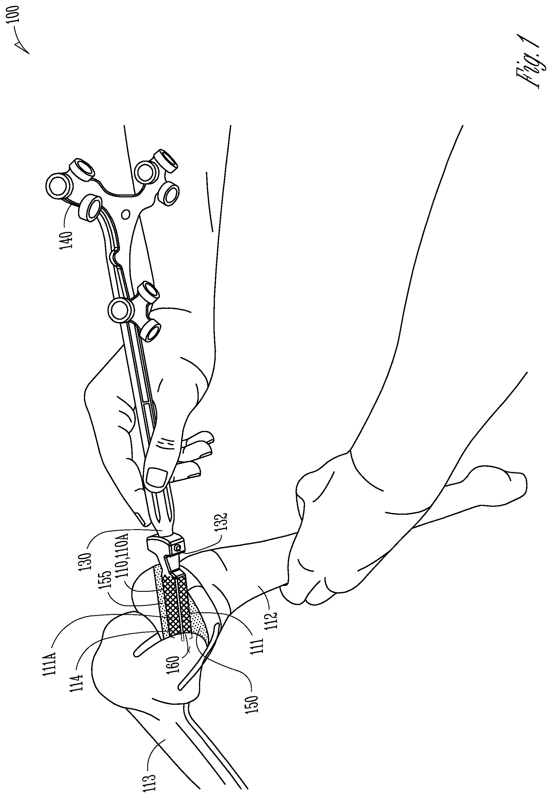 Patent US12616530 Figure 1 – Knee arthroplasty combination validation instrument and bone removal tool