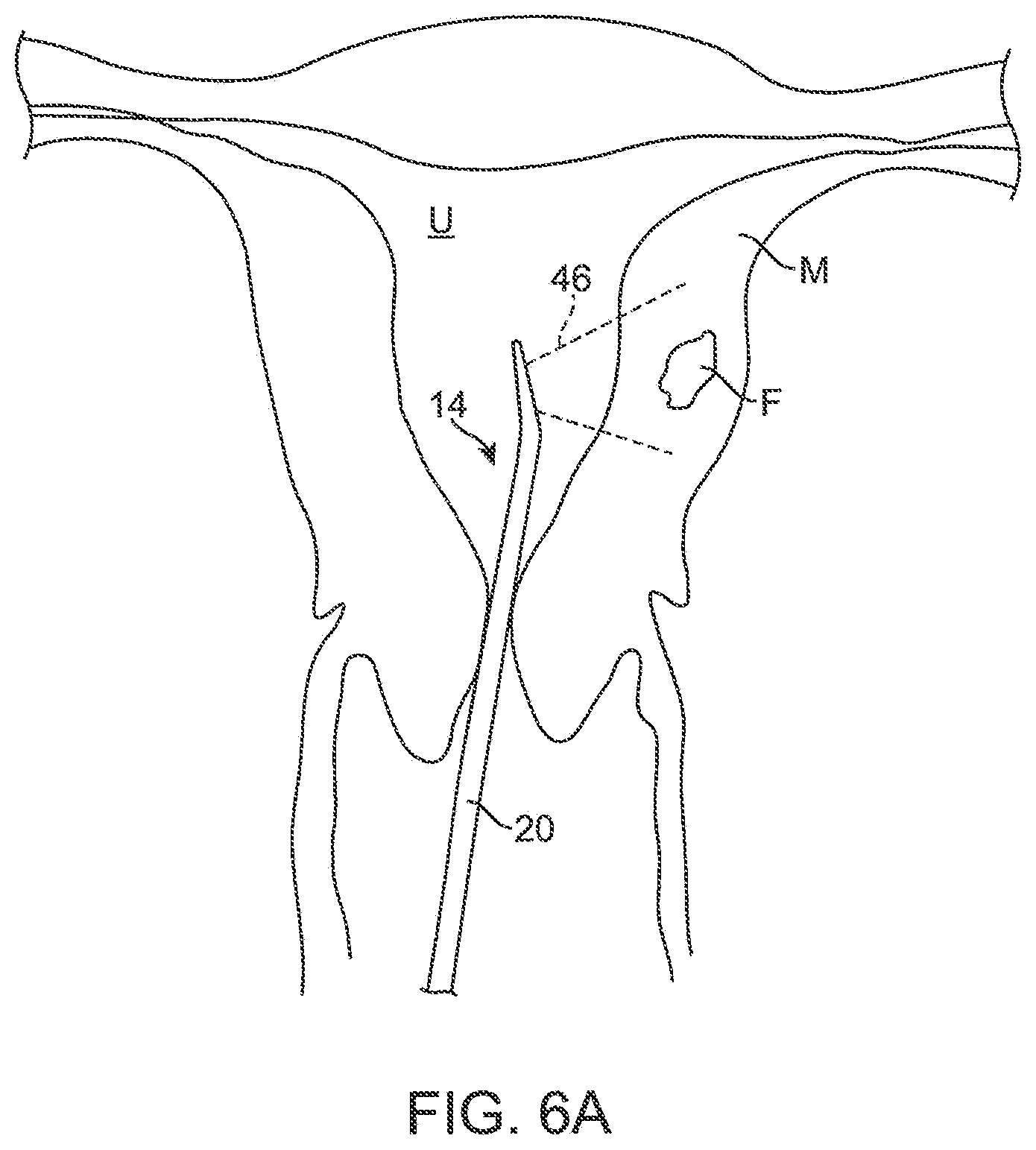 Patent US12616549 Figure 5 – Methods and systems for controlled deployment of needles in tissue