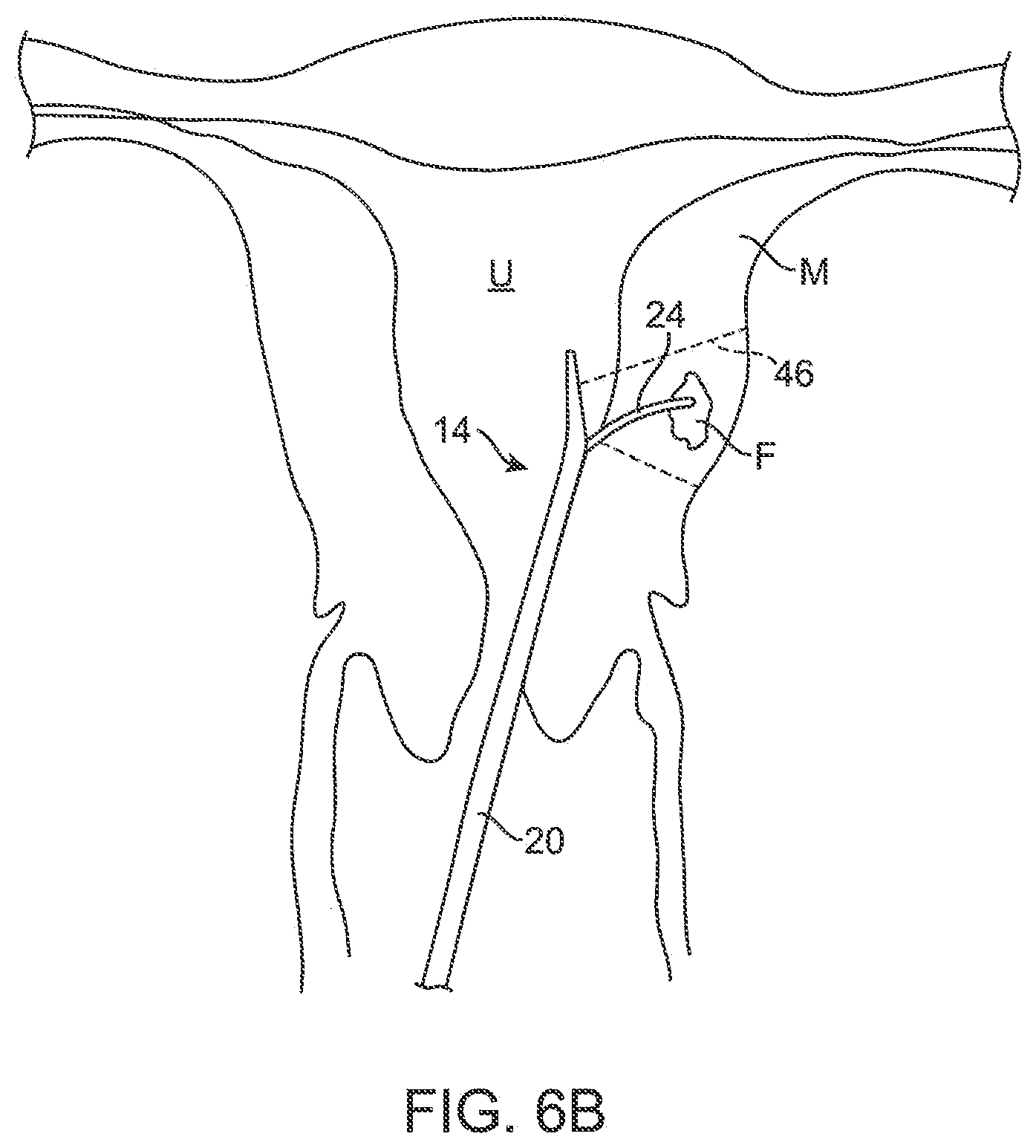 Patent US12616549 Figure 6 – Methods and systems for controlled deployment of needles in tissue
