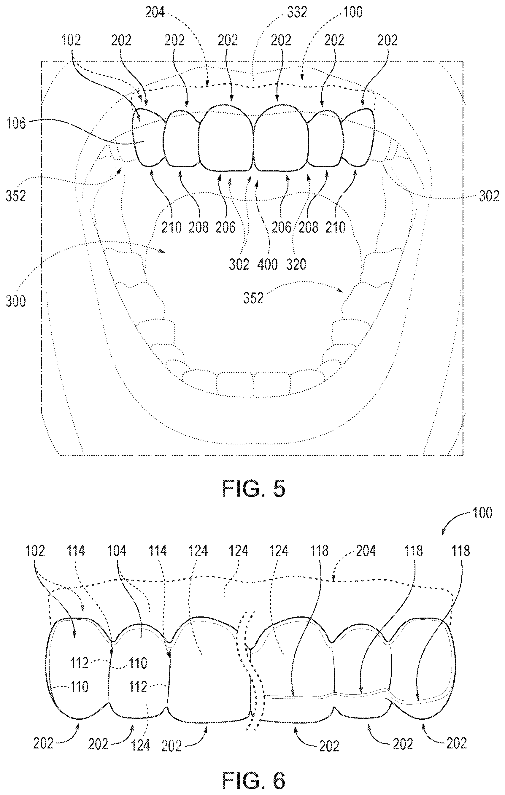 Patent US12616554 Figure 4 – Customized temporary veneers and methods of providing the same