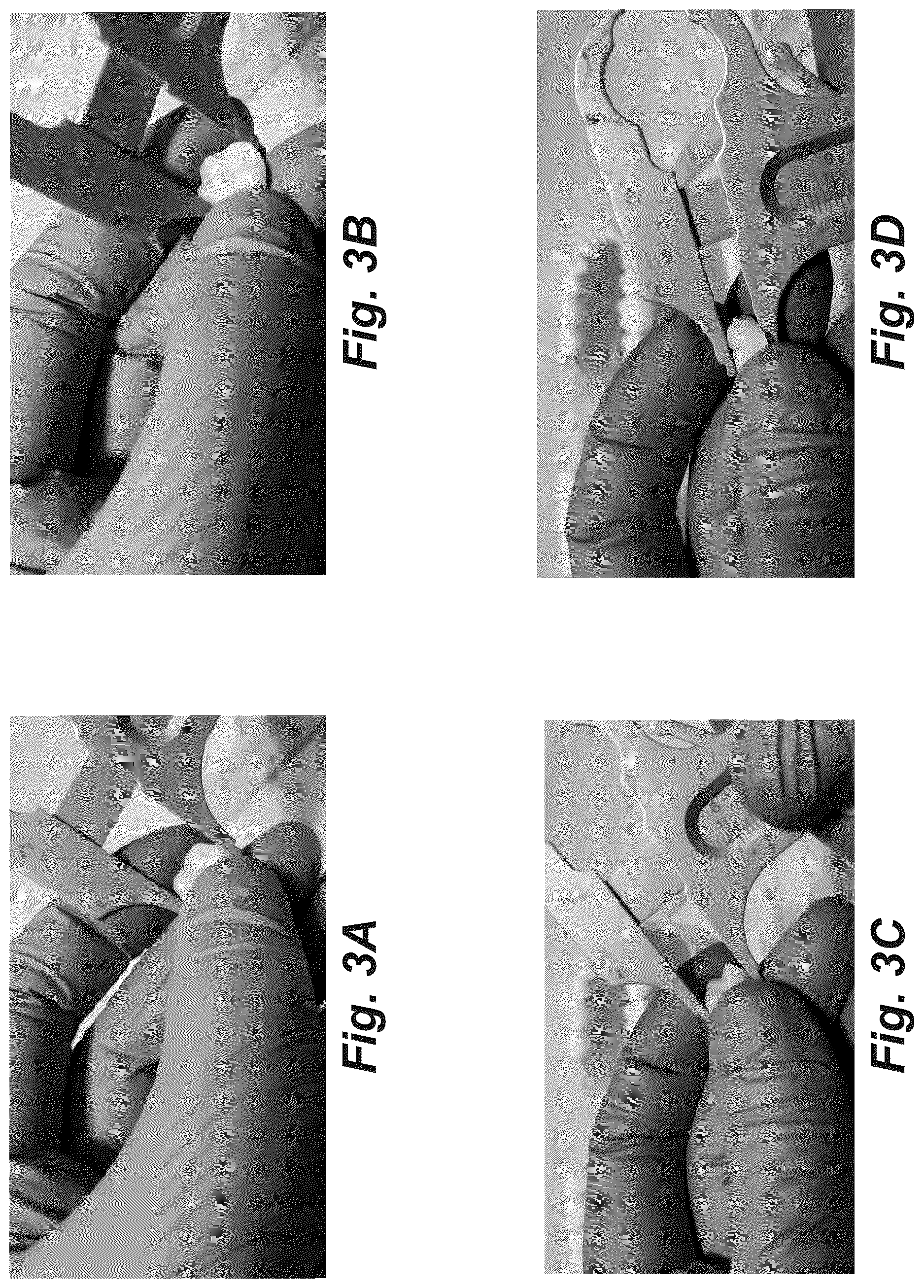 Patent US12616555 Figure 6 – Dental crown and method of use