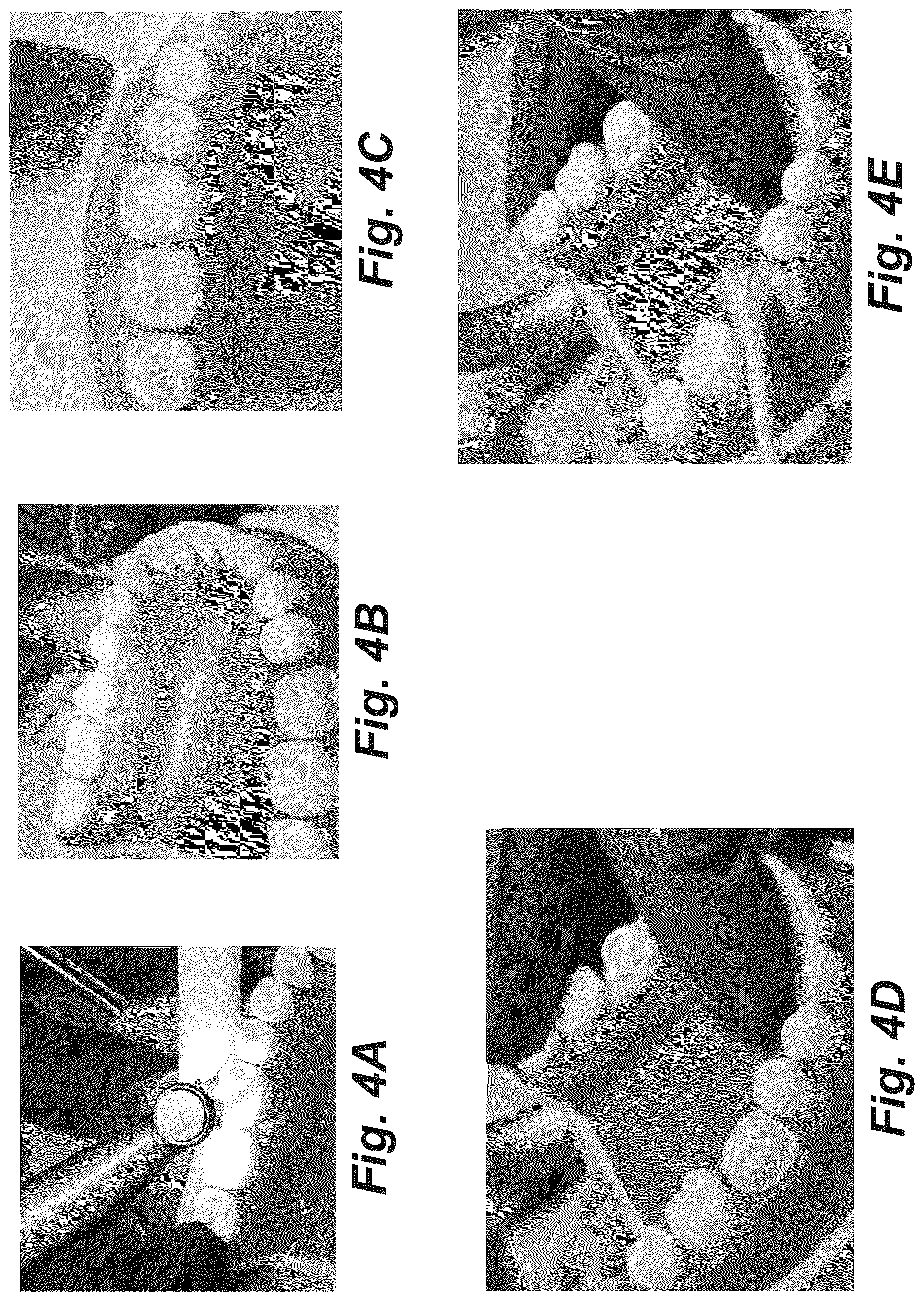 Patent US12616555 Figure 7 – Dental crown and method of use