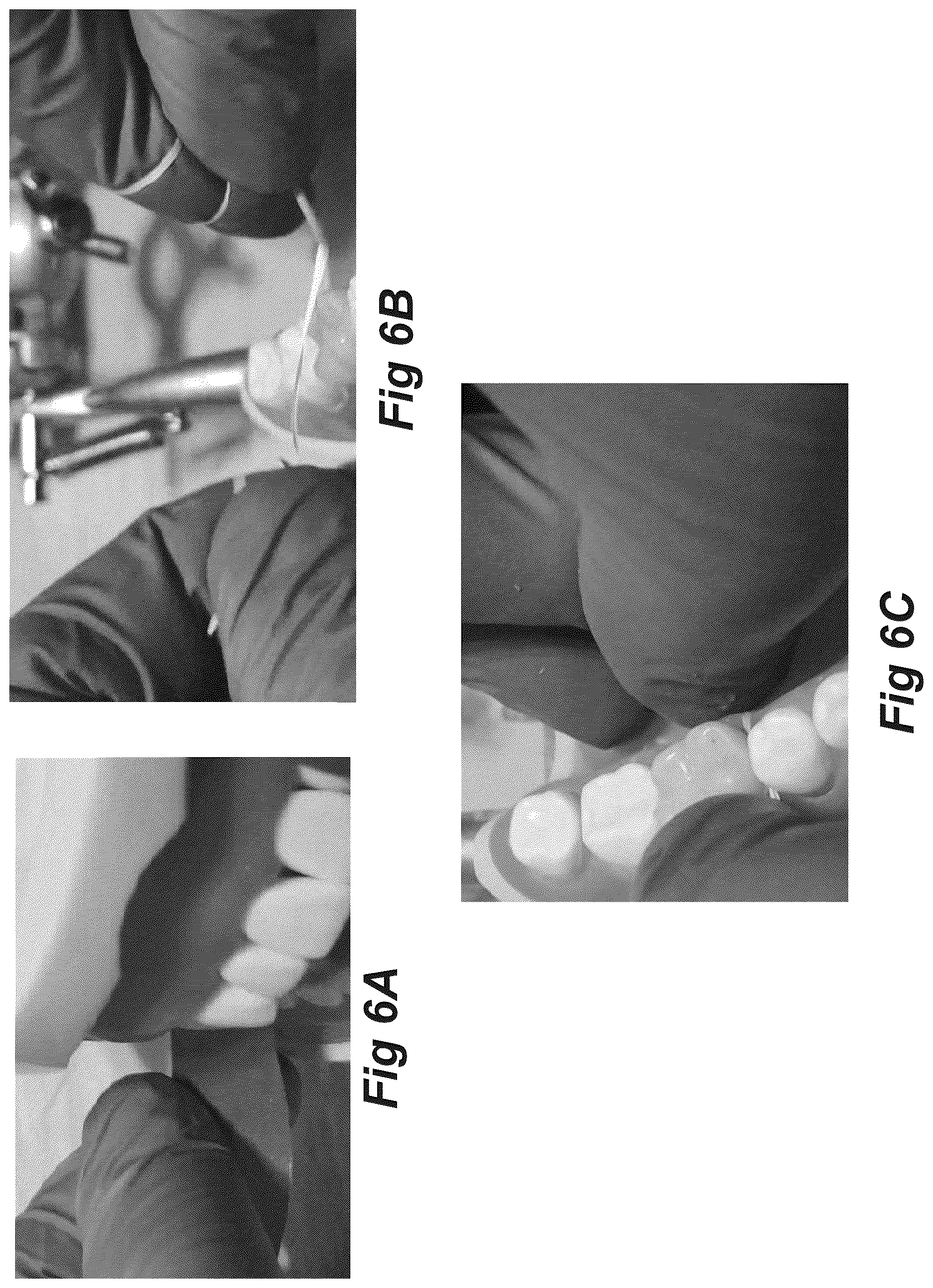 Patent US12616555 Figure 9 – Dental crown and method of use