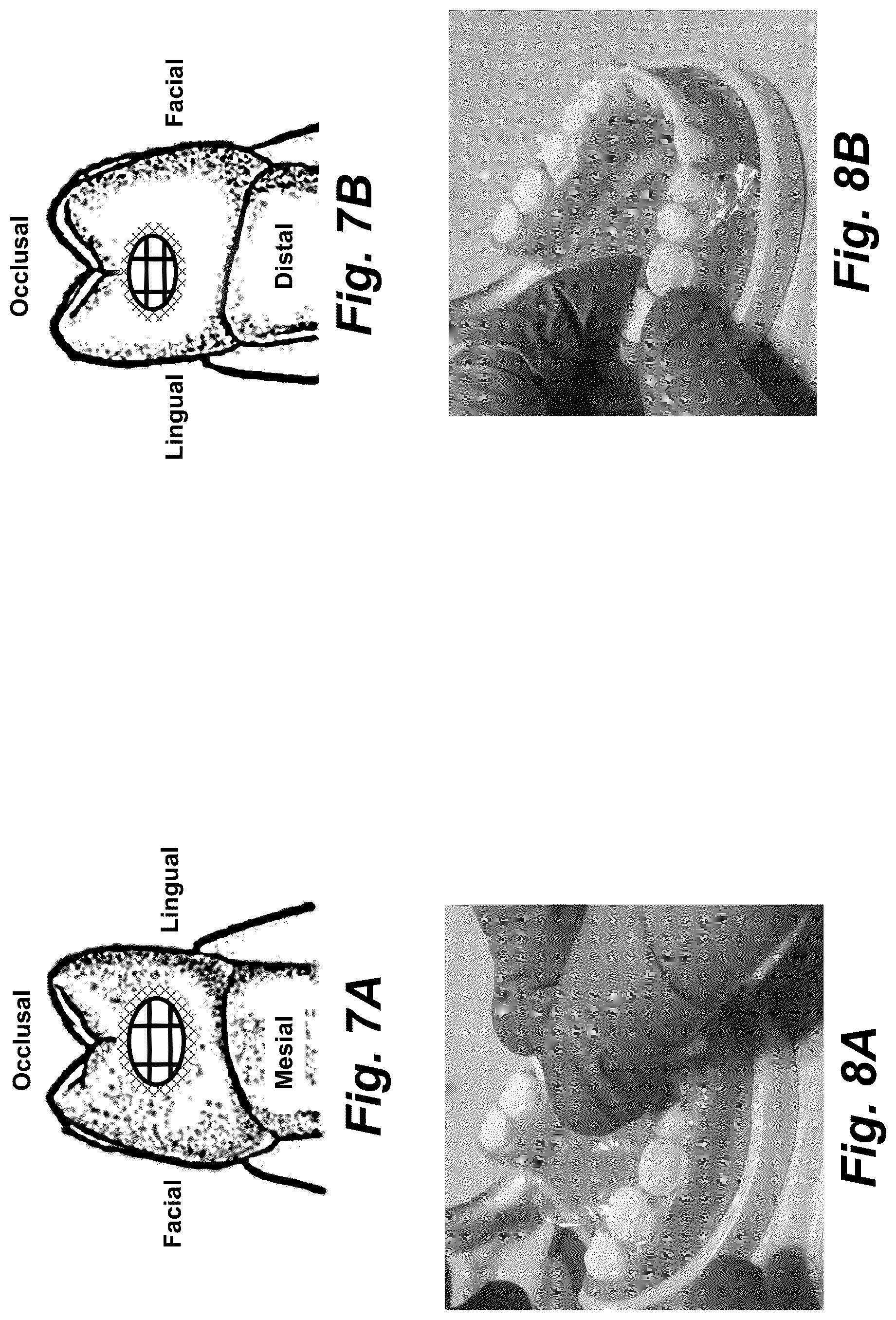Patent US12616555 Figure 10 – Dental crown and method of use